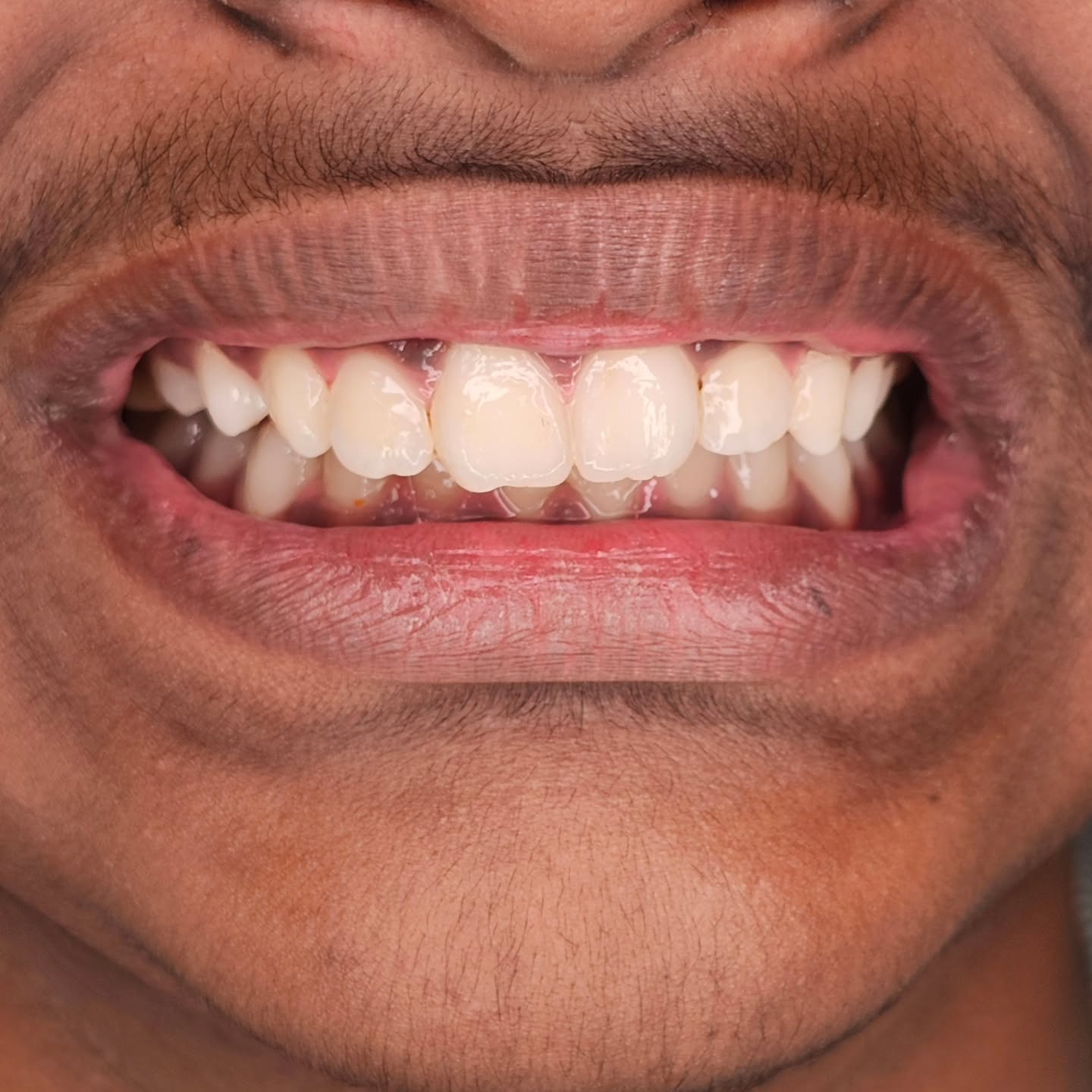 Dental arch form correction for a 14 year young boy using clear aligners . Pictures showing Wonderful results
Clear Aligners are the most comfortable and go to option for correction of malaligned teeth.
Precise, Pleasant and Aesthetic Dentistry By Dr. Sethuraman Ramadoss at Sethu's Dental House
Contact 97892 47362 for dental queries
#clearaligners #invisiblebraces #invisalign #orthodontics #chennai #chrompet #sethusdentalhouse #dentistry