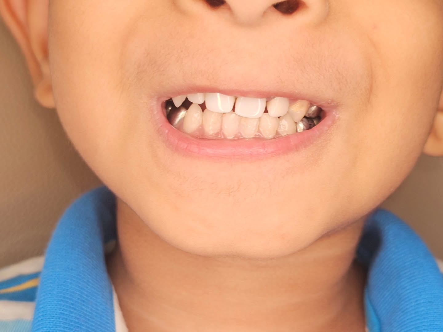 A transformation worth smiling about! 😁
A complete transformation of the smile and confidence of our brave 4 year old patient. He completely skipped the dental trauma by opting for general anaesthesia and will only remember the comfort and new teeth he has now. Thanks to Dr. Anand Kasi for his dedicated work.
#toothfairy #Zirconia #smilegoals #confidentkids #incrediblejourney #brightsmiles #pedodontics
#smiletransformation #kidsdentistry #kidsdentist