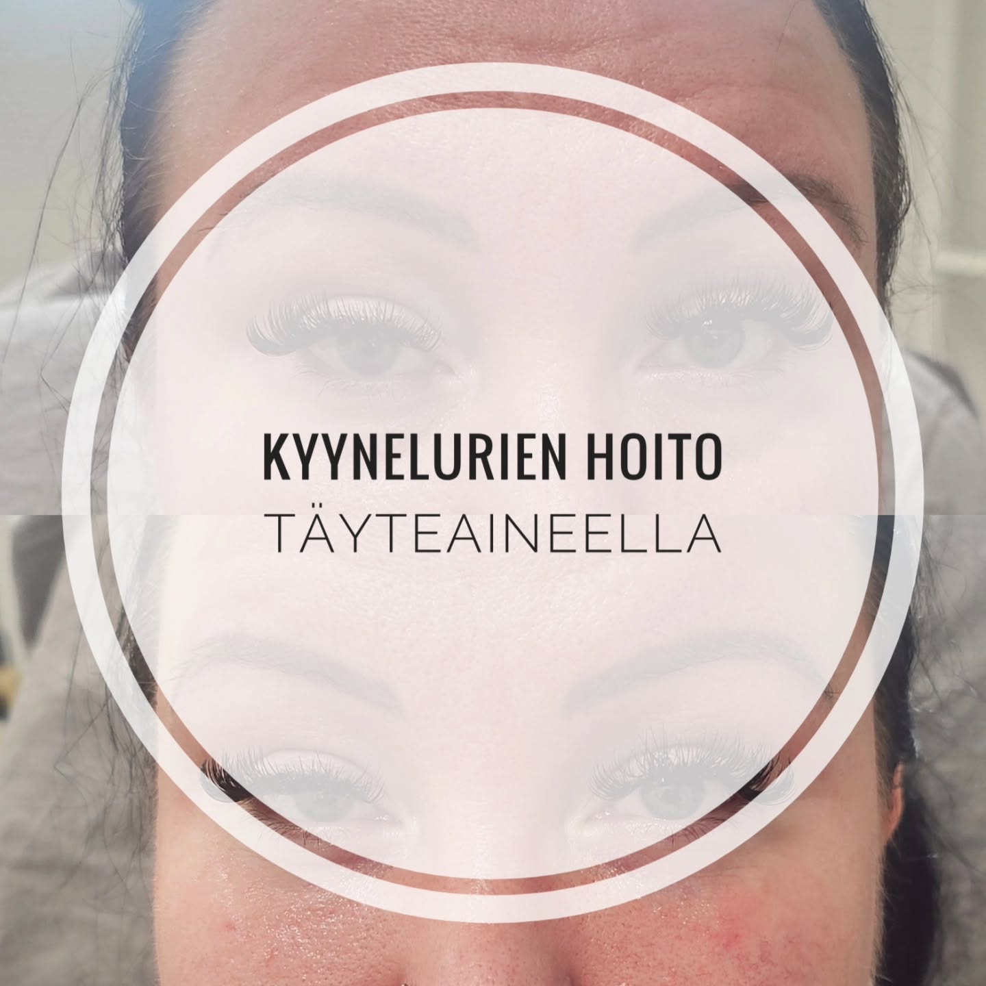 Kyynelurien täyttö täyteaineella. ✨️
Oikein toteutettuna ja oikeanlaisella ainevalinnalla kyynelurien täyttö on turvallinen ja hyvä keino häivyttää silmänalusten tummuutta ja kuoppaisuutta.
Asiakas oli tyytyväinen välittömästi näkyvään muutokseen. Hänen ilme oli 😲 kun katsoi peiliin ja huomasi hoitotuloksen. 😄
#täyteaine
#turku
