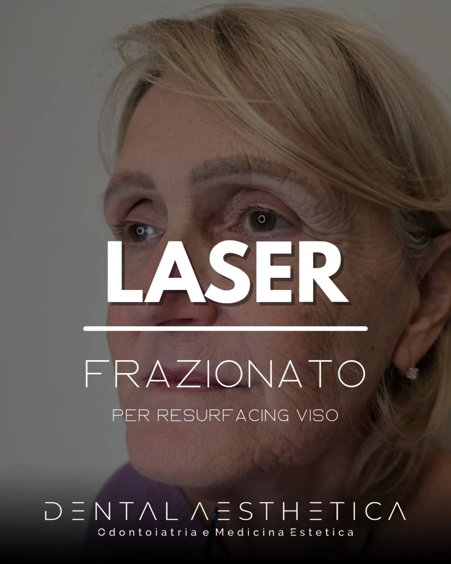 💫 Resurfacing viso, che cos'è?
Trattamento eseguito con laser ablativo in 3/4 sedute per ottenere:
💎 Pelle rigenerata con colorito piu vivace
💎 Riduzione delle rughe piu sottili
💎 Turgore generale del viso
💎 Texture della pelle migliorata
⛔️ Ha un difetto: è un trattamento costoso.
E tu, te la senti di investire nella tua bellezza?
Faccelo sapere scrivendoci in privato!
#medicinaestetica #nofilter #Roma #laser #ringiovanimentoviso