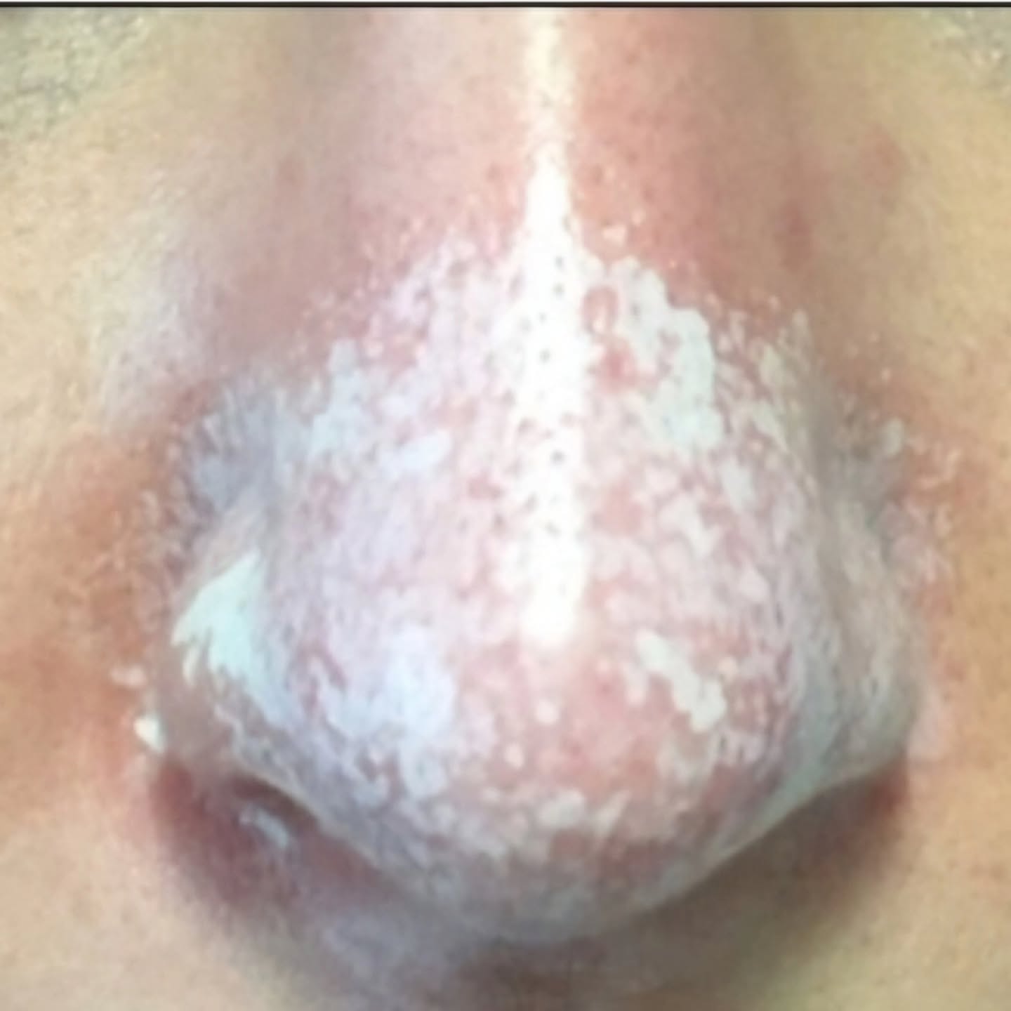 You can have an Acid Nose Peel to pre-condition your nose skin before a nose job if you have thick skin.
The team have worked hard to publish this Nose Skin Thickness Scale which Grades nose skin from Grade 1 for Super Thin skin to Grade 5 Very Thick skin.
The British Journal of Plastic Surgery looked at 166 of our Rhinoplasty patients and found that patients with thick skin got some benefit from an Acid Peel before their surgery.
Download the article from JPRAS website.