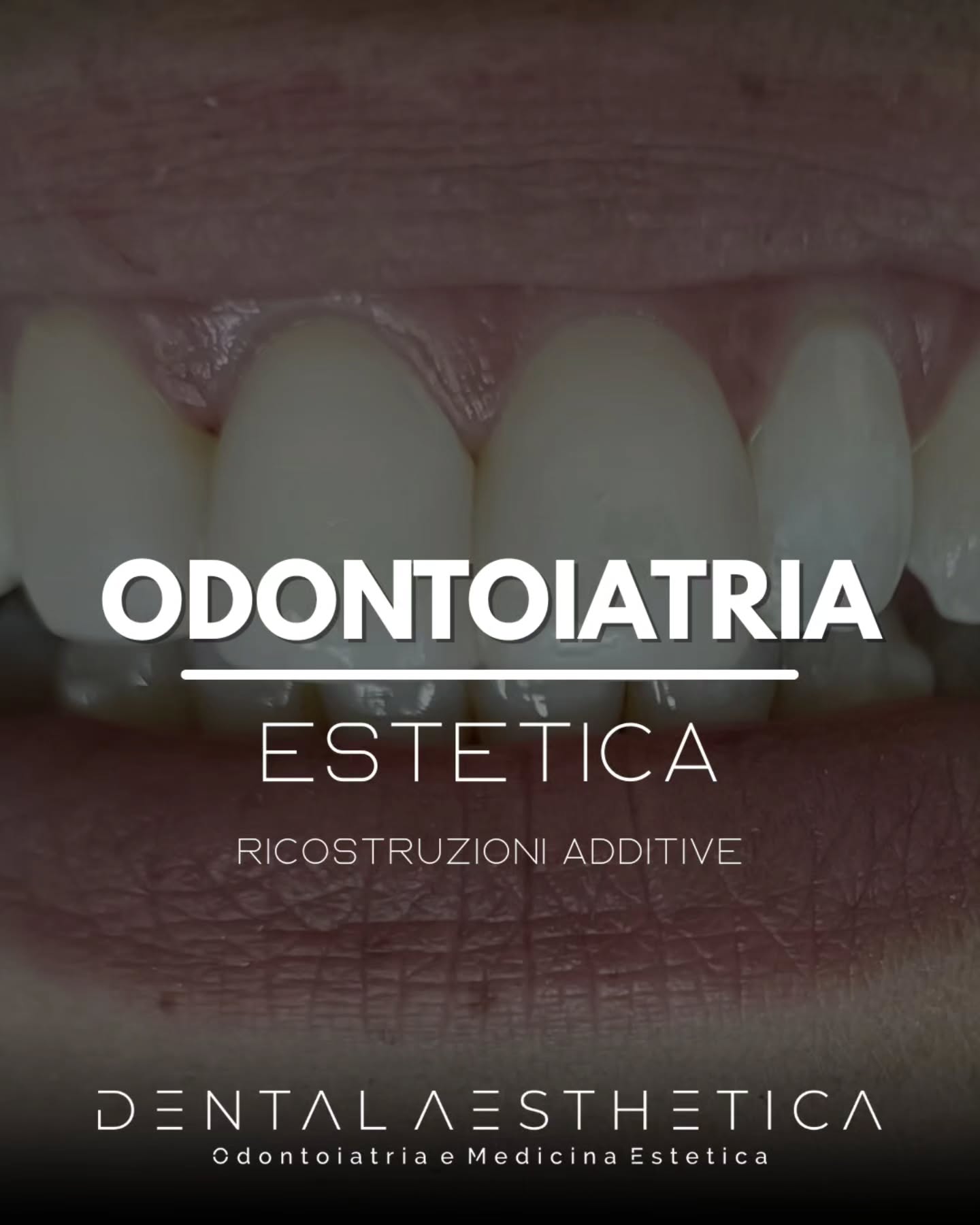 Denti scheggiati che compromettono l'estetica e la simmetria del tuo sorriso?
Con questa paziente abbiamo intrapreso una ricostruzione estetica additiva che ha donato nuova proporzione al suo sorriso.
I vantaggi di questa tecnica?
✅️ Più economica rispetto alle faccette in ceramica
✅️ Non serve limare i denti del paziente
✅️ Prova con composito provvisorio
✅️ Risultato duraturo
Dental Aesthetica
📍 viale della Grande Muraglia 256, zona EUR-Torrino
📱 375 88 47 069
#dentista #dentistaroma #faccette #sorriso #sorridere