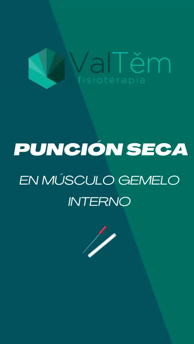💉 ¿Sabes como realizamos en fisioterapia la técnica de punción seca? 💡
La punción seca es una técnica utilizada por fisioterapeutas para tratar puntos gatillo miofasciales (puntos localizados en bandas tensas musculares). En este video te mostramos el procedimiento paso a paso para aplicarla en el músculo gemelo interno, clave para aliviar tensión y mejorar la función del mismo👇
1️⃣ Preparación de la zona: Aplicamos un poco de clorhexidina para garantizar una buena higiene antes de comenzar. ✅
2️⃣ Limpieza: Aseguramos que la piel esté completamente limpia para evitar cualquier tipo de infección. 🧼
3️⃣ Técnica precisa: Con una toma "en pinza" localizamos el músculo y realizamos la punción de forma segura y efectiva. 🖐
🔎 La punción seca es ideal para tratar molestias musculares crónicas y/o agudas.
Ojo! Siempre debe ser realizada por profesionales capacitados para garantizar tu bienestar.
📩 Si tienes alguna pregunta o necesitas más información sobre esta técnica, no dudes en escribirnos. ¡Estamos aquí para ayudarte! 🙌
#PunciónSeca #Fisioterapia #SaludMuscular #ValTemFisioterapia #CuidadoPersonal
