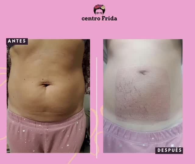 ¿Flacidez en el abdomen?
Ahora es posible corregir y devolver la firmeza en la piel en el área abdominal.
✨️SIN CIRUGIA✨️
La flacidez en el abdomen puede ser tratada de varias maneras, y el tratamiento de fibroblast es una opción interesante en tratamientos de rejuvenecimiento y tonificación de la piel. Con la técnica de fibroblast conseguimos células que producen colágeno y elastina, esenciales para mantener la elasticidad y firmeza de la piel.
Los resultados son INMEDIATOS Y PERMANETES.
✅️ SIN CIRUGIA
✅️ SIN DOLOR
✅️ SIN CICATRICES
📲 624252194
#plasmapenmadrid #fibroblast #abdomen #abdomencaído
#foacidez #plasmapen