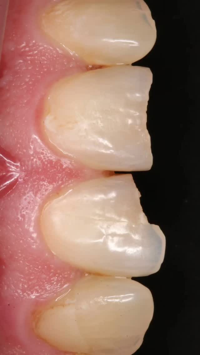 Reconstrucción de dientes por fractura utilizando resina compuesta. Resultados en 1 sesión ✔️#saluddental #estéticadental #sonrisaperfecta