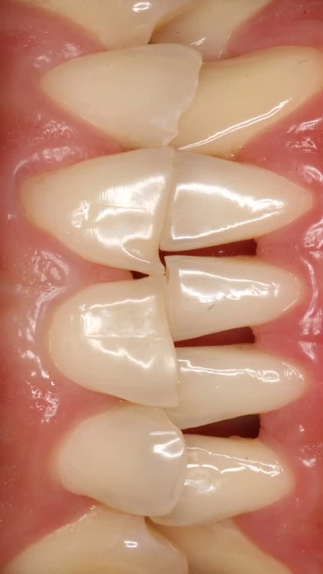 Resinas compuestas, devolviendo funcion y estética en sector anterior.