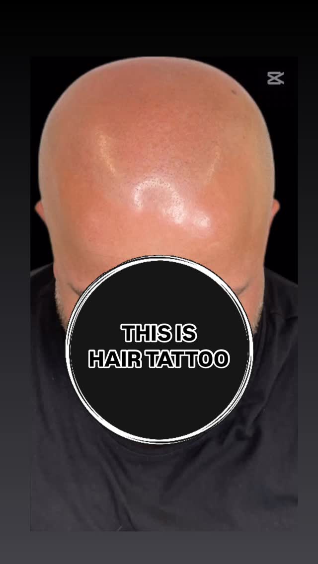 Don’t like to be bald? Tried everything to handle baldness? Then it’s time for SMP!
Scalp Micropigmentation, or SMP, is a great technique to deal with baldness without fuss of the surgery and downtime. 
Get the appearance of a freshly shaved head 24/7. 
Feel free to contact me and ask any questions about SMP. 
✅ I am Sergei Shaikhulin, your SMP expert with 4 years of experience. And  I am the owner of the Certified SMP studio in Helsinki, Finland 🇫🇮 
🗓 Book a FREE initial consultation to get:
- answers to all your questions,
- a plan of SMP for your type of hair-loss, 
- price for your case.
🗣We speak EN, FI, RU. 
#smp #scalpmicropigmentation #scalptattoo #hairtattoo  #трихопигментация #micropigmentation 
#balding #hairloss #alopecia
#HairLossTreatment 
#helsinki #Finland #smpfinland