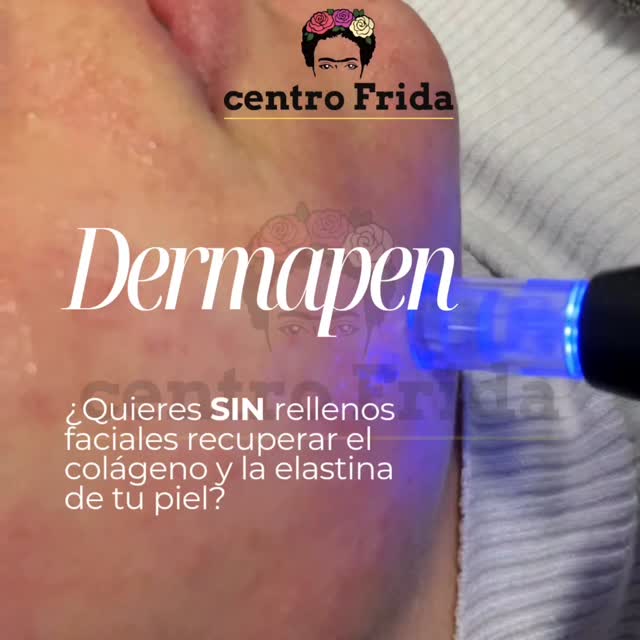 ¿Que es dermapen? Es un dispositivo que realiza una perforación de la piel y esa perforación va a jenerar una series en cadena, que es lo que logramos busca, regenerar la piel.
✅️ Piel grasa
✅️ Piel con acné
✅️ Piel con cicatrices
✅️ Regenerar y produce colágeno
✨️ Piel de porcelana ✨️
#dermapen #pielsana #pielgrasa #pielperfecta #acane #cicatrices #plasmapenmadrid #colageno