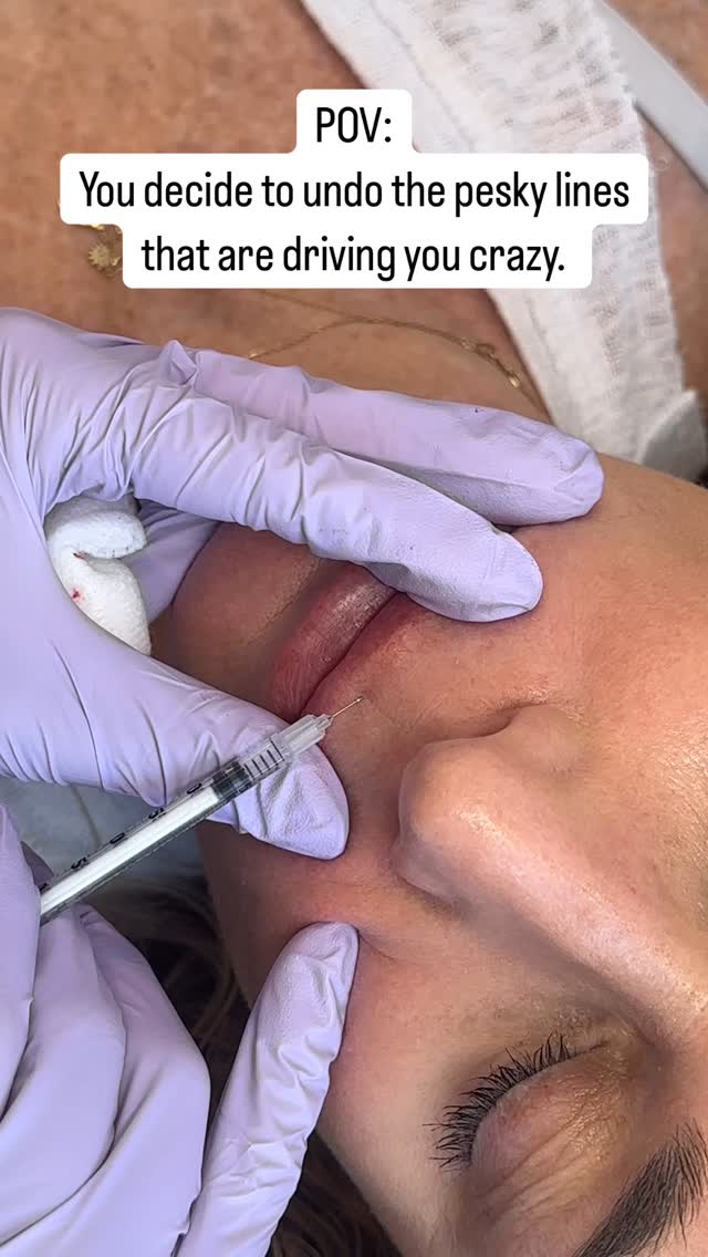 With the right product, technique and a bit of patience, you can *immediately* erase pesky lines in the skin without adding volume.
Whats that look like in the mirror? Erasing diagonal lines on the forehead (side sleepers), fine lines around the mouth (straws, smokers, anyone in general), or radial lines on the cheeks etc.
Yes it takes a little time to settle down but you can watch them soften right before your eyes and it is SOOO satisfying😝