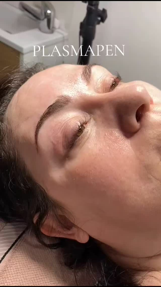 ✨️ No más párpados caídos ✨️
✅️ Elimina Flacidez
✅️ Elimina arrugas
✅️ Sin Dolor
#plasmapenmadrid #esteticamadrid #dermapenmadrid #plasmapen #microblading #fibroblast #plasmafibroblast #flacidezfacial #parpadoscaidos
