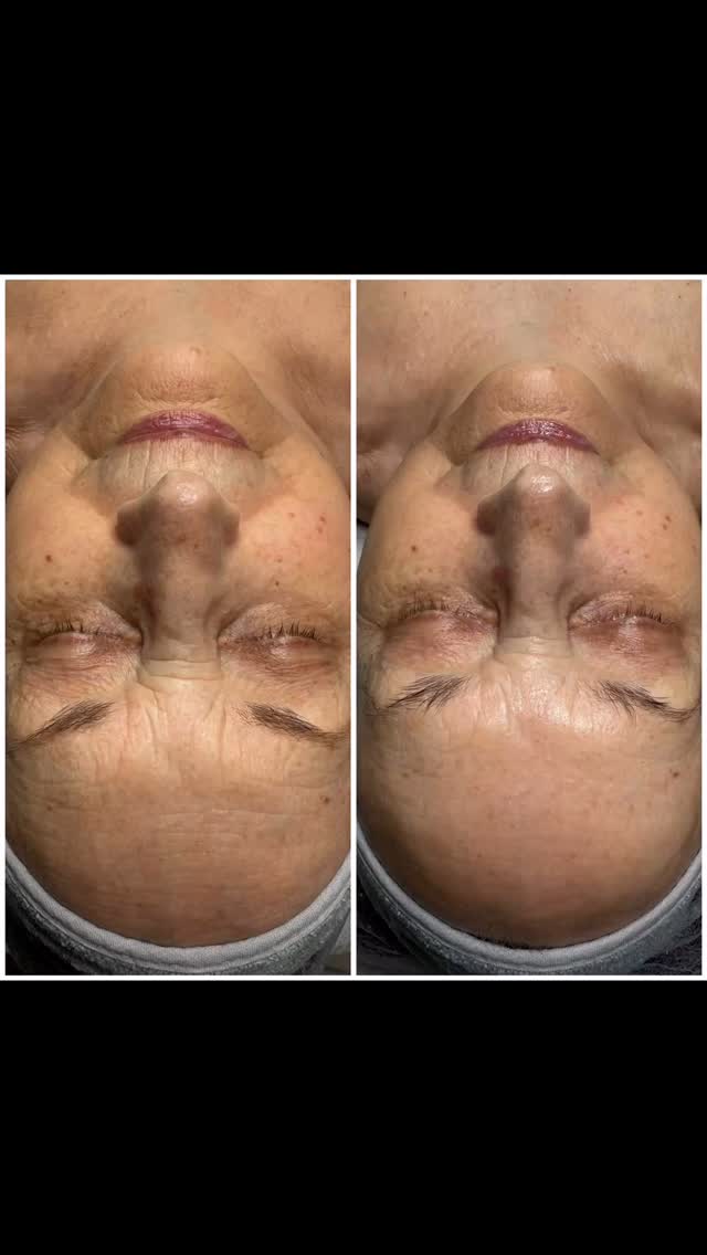 #new #treatment #neosino #fashionbeautyszepsegszalon #kozmetikabudapest