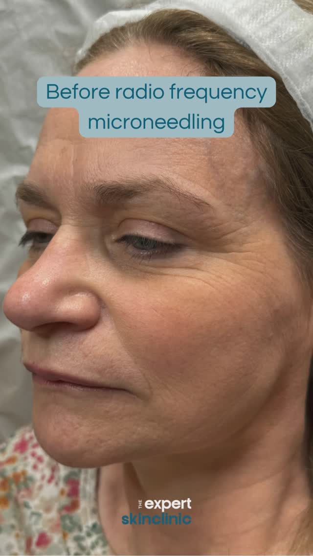 Wow, these results show the immediate results radio frequency microneedling gives!
The glow you get from these two innovative treatments combined is unmatched✨
Microneedling works organically to trigger the skin’s wound healing response, creating new collagen and elastin fibres.
Radio frequency adds skin tightening to smooth and lift the complexion.
This treatment will give you...
✅ Smoother, tighter skin
✅ More even skin tone
✅ Reduced pores
✅ Plump, glowy complexion
An excellent one for tired, winter skin in need of a boost. Learn more about this treatment on our website on the microneedling page and stay tuned for the final results!