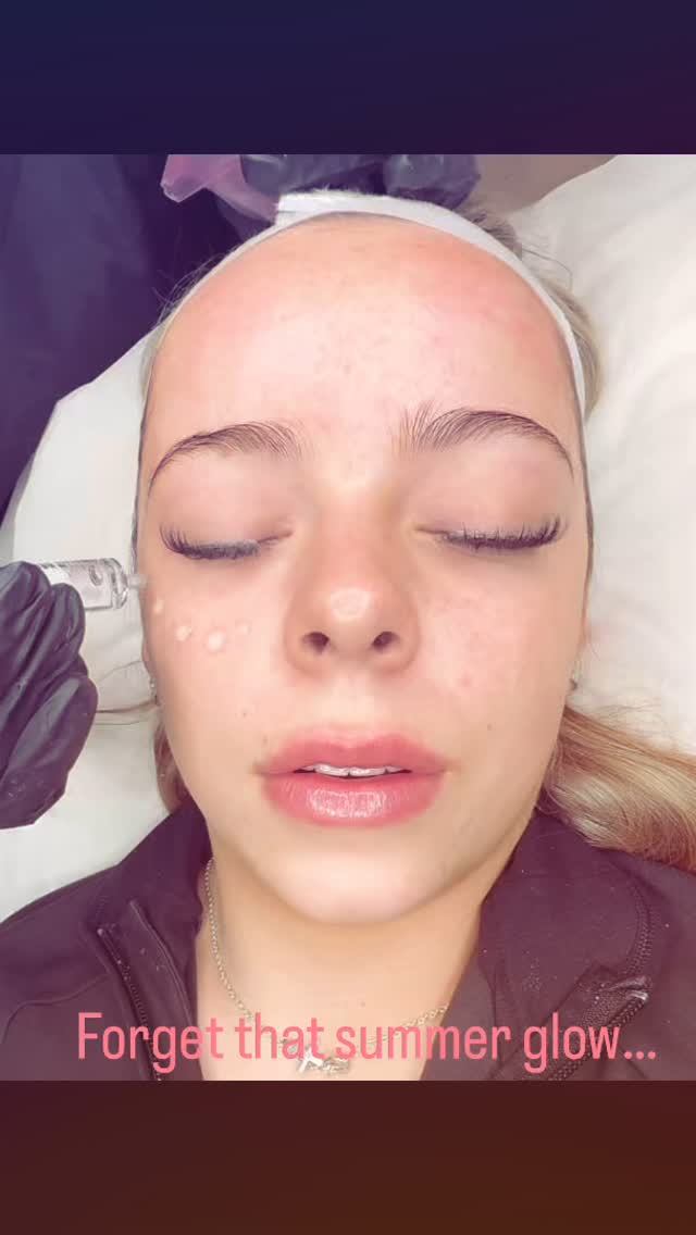 Why risk your skin in the sun this summer? ☀️
❌ Forget that summer glow… it’s time for your instant inner glow with our BB Glow treatment! ✨💖
Ditch the sun damage and achieve a naturally radiant, even-toned complexion all year round! Our BB Glow treatment infuses your skin with nourishing serums, boosts collagen, and enhances your natural glow—giving you that lit-from-within, flawless finish without makeup!
✔️ Evens out skin tone
✔️ Reduces redness & discoloration
✔️ Hydrates & revitalizes
✔️ Long-lasting radiant glow
Got an event coming up? BB Glow is the perfect pre-event prep for smooth, flawless skin, so you look effortlessly radiant in photos! Plus, with your skin already glowing, you’ll feel confident skipping makeup for weeks.
Protect your skin and glow the safe way—book your first BB Glow session today! ✨
#BBGlow #FlawlessSkin #GlowingComplexion #NoMakeupGlow #EventReady #HealthySkin #WollongongSkin #IllawarraSkin #LaBelleSkinTherapy