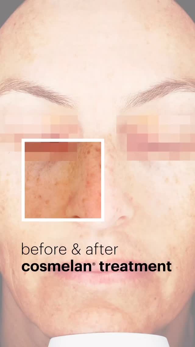 Posted with @withregram, @mesoestetic.australia
✨ Transform Your Skin with Cosmelan ✨
Cosmelan is a powerful depigmentation treatment that targets dark spots, melasma, and uneven skin tone. Packed with active ingredients, it works deep within the skin to block the production of melanin and promote a radiant, flawless complexion.
Book your appointment today for a personalize consultation and treatment plan.
https://www.kewskintherapy.com.au/
Kew Skin Therapy
📍174 High Street, Kew, VIC 3101
📞(03) 9853 4544
#Mesoestetic #Cosmelan #SkinCare #GlowingSkin #Depigmentation #FlawlessComplexion #Beauty #SkincareTreatment #RadiantSkin
