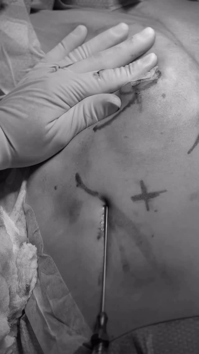 Excelente resultado de Aumento mamario 💞 ¿qué opinas de esta hermosa transformación?