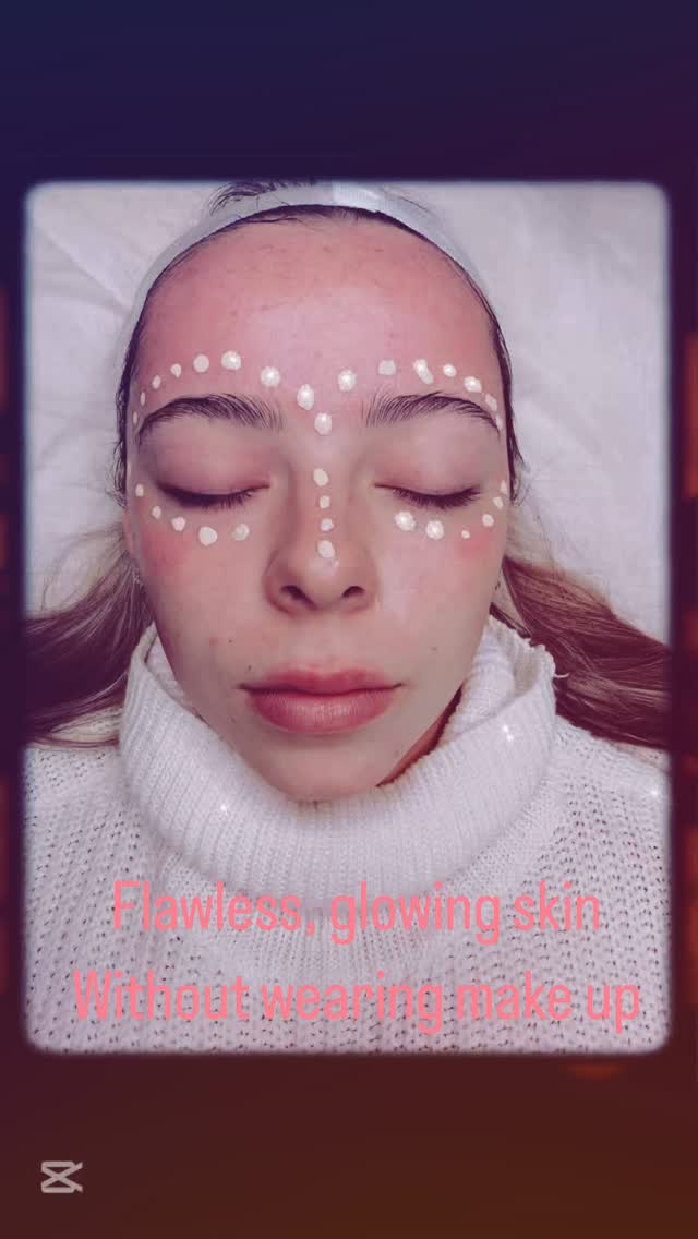 ✨ Flawless, Radiant Skin – No Filter Needed! ✨
Want that effortless glow without layers of makeup? Our BB Glow treatment combines the power of microneedling with a semi-permanent skin-boosting serum to give you:
✨ Smoother skin texture – thanks to microneedling’s collagen-boosting effects
✨ Even complexion – reduces redness, pigmentation & dullness
✨ A natural, makeup-free glow – wake up looking radiant every day!
Perfect for those who love low-maintenance beauty with high-impact results. Book your BB Glow session today and let your skin shine! ✨
BB Glow coverage is gradually built up over 3-6 sessions, allowing the skin to absorb the serum for a flawless, even complexion with long-lasting results.
#BBGlow #FlawlessSkin #GlowUp #EvenComplexion #MakeupFreeGlow #WollongongSkin #IllawarraSkin #LaBelleSkinTherapy