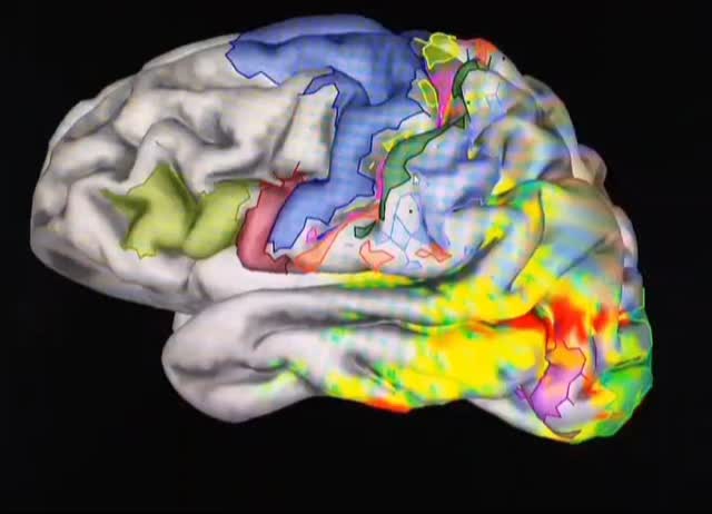 Combining quantitative structural brain measures from MRI with millisecond-wise brain activity measures from MEG in one patient. Building on methods developed more than 10 years ago. Download one of the pubs here:
Atypical right hemisphere specialization for object representations in an adolescent with specific language impairment. Frontiers in Human Neuroscience, Brown et al., 2014.
https://www.frontiersin.org/journals/human-neuroscience/articles/10.3389/fnhum.2014.00082/full
Cheers. š§ āļø
#MEG #MRI #aMEG