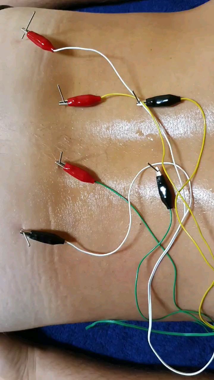 Abordaje con neuromodulación en un paciente con dolor lumbar de varios años de evolución.
✅ Ideal para patologías que llevan tiempo sin solucionarse y han pasado a ser parte de nuestras vidas
#fisiodosrius #fisioinvasiva #fisioterapia #dolor #dolorlumbarcronico #lumbalgia #gluteos #dolorcronico #neuromodulacion #electroestimulacion #electroterapia #rehabilitación