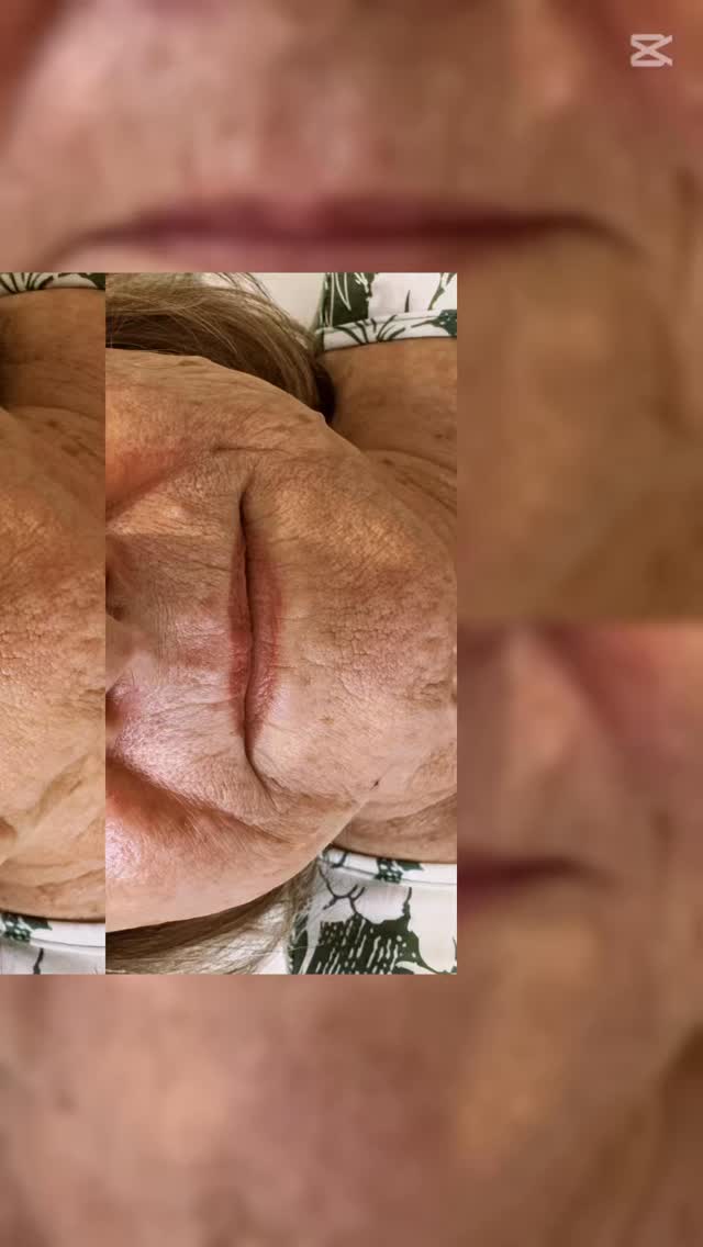 A great example of making a little filler in the RIGHT place go a LONG way. Using @teoxaneofficial RHA3, 1ml to treat marionette lines.
It’s only the beginning of this lovely lady’s skin journey but seeing such great results so soon is certainly a happy lift.
@teoxane_uk
#marionettelines #rejuvenation #dermalfiller #skin #lift #winchester #aesthetic #hampshireaesthetics #medicallytrained #1ml #position #correct #injector #gotyou