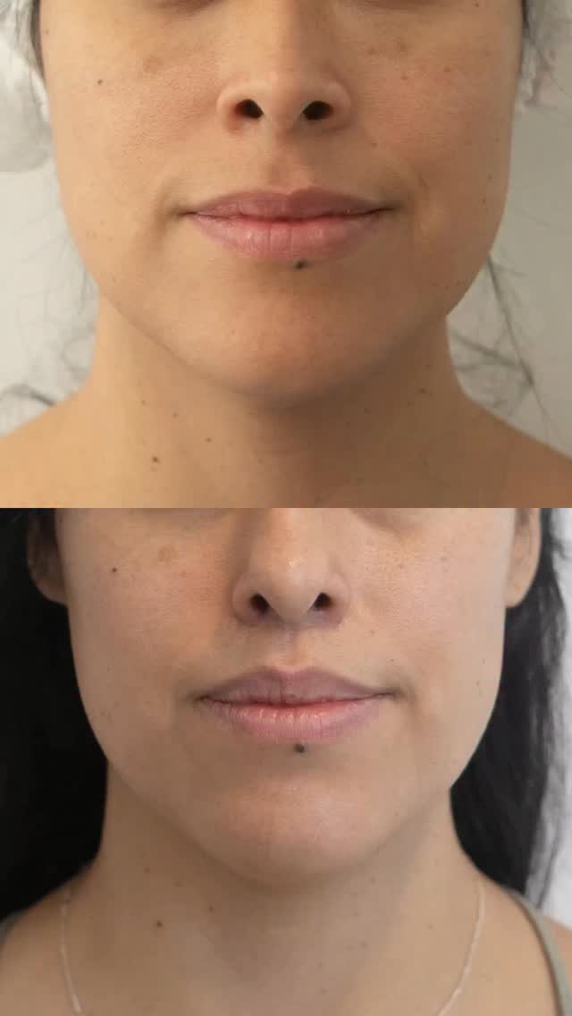 Quiero comenzar esta semana compartiendo con ustedes un resultado de Upper Lip Lift muy natural y armónico que logro potenciar la belleza y las facciones de nuestra paciente 🩵 recuerden que en nuestra tienda www.rrtienda.com pueden encontrar toda la información de nuestros servicios disponibles