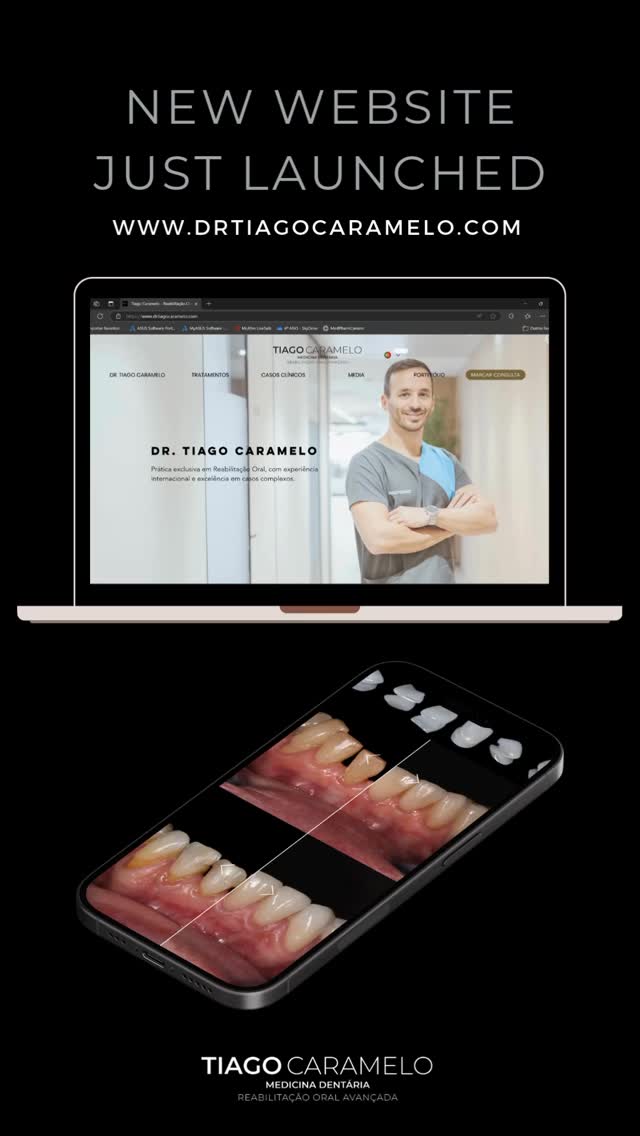 Após 11 anos dedicados à reabilitação oral na Malo Clinic, decidi criar um espaço online onde pudesse reunir e apresentar o meu percurso profissional, de forma estruturada e acessível.
Este site nasce com o propósito de dar a conhecer não só a minha formação académica e experiência clínica, mas também a minha filosofia de trabalho, os princípios que regem a minha prática diária e, acima de tudo, os casos clínicos que ilustram o compromisso que tenho com cada paciente.
Acredito que a confiança se constrói com transparência, conhecimento e disciplina. Por isso, este projecto digital não é apenas uma amostra do que faço, mas também uma forma de partilhar a dedicação que coloco em cada detalhe da minha profissão.
Convido-vos a visitar o site, explorar os conteúdos e conhecer um pouco mais sobre mim e sobre a forma como vejo a medicina dentária. Será um privilégio continuar a merecer a vossa confiança — agora também neste novo formato.
👉 Descubra mais em www.drtiagocaramelo.com
📍 Lisboa | Malo Clinic | Reabilitação Oral
—————————————————————————————
After 11 years dedicated to oral rehabilitation at the Malo Clinic, I decided to create an online space where I could bring together and present my professional journey in a structured and accessible way.
This website was created with the aim of showcasing not only my academic background and clinical experience, but also my working philosophy, the principles that guide my daily practice, and, above all, the clinical cases that reflect the commitment I bring to each patient.
I truly believe that trust is built through transparency, knowledge, and discipline. That is why this digital project is not just a sample of what I do, but also a way of sharing the dedication I put into every detail of my profession.
I invite you to visit the website, explore its contents, and learn more about me and the way I approach dentistry. It will be a privilege to continue to earn your trust — now also in this new format.
👉 Learn more at www.drtiagocaramelo.com
📍 Lisbon | Malo Clinic | Oral Rehabilitation
#dentist #oralhealthcare #dentistry #newebsite