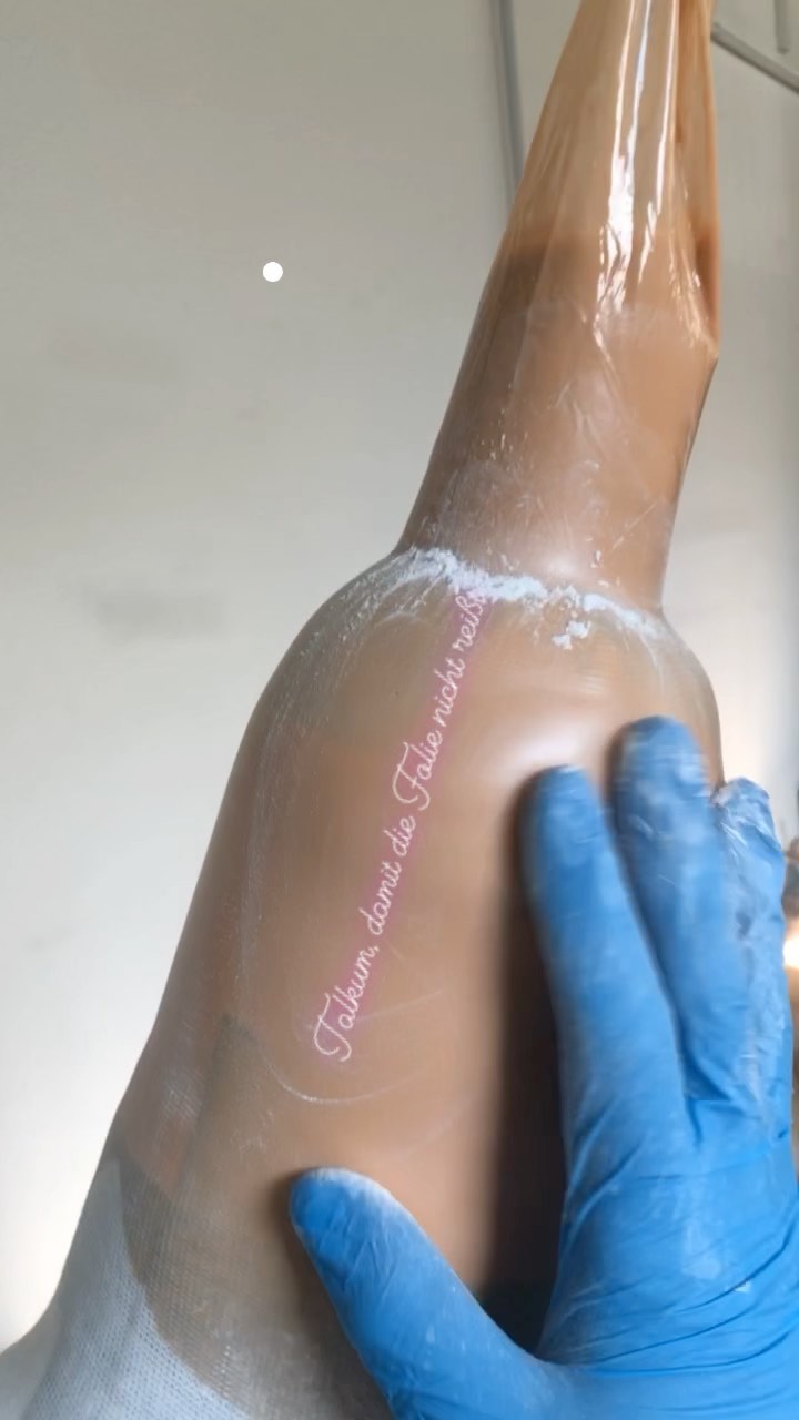 Erster Schritt des Einbaus eines RevoLock Lanyard von @clickmedical
🇬🇧 first lamination for a RevoLovck Lanyard in a TF-socket (2nd step will follow soon)
Hier im 2-Stufen-Laminat, da der Anschlussadapter ja noch platziert werden muss.
Einbau des Kabelkanals etc. folgt im nächsten Reel
#orthopädietechnik #oandp #ot #oberschenkelprothese #prosthesis #abovekneeprosthesis #prothese #prosthetics #beinprothese #protheseus #clickmedical #revolocklanyard #prostheticleg #amputiert #amputee #amputeelife #lifestylemedicine #handwerk #handmade #handcrafted #handwerksstolz #handarbeit #howto #lustaufhandwerk #custommade #meinhandwerkhilft