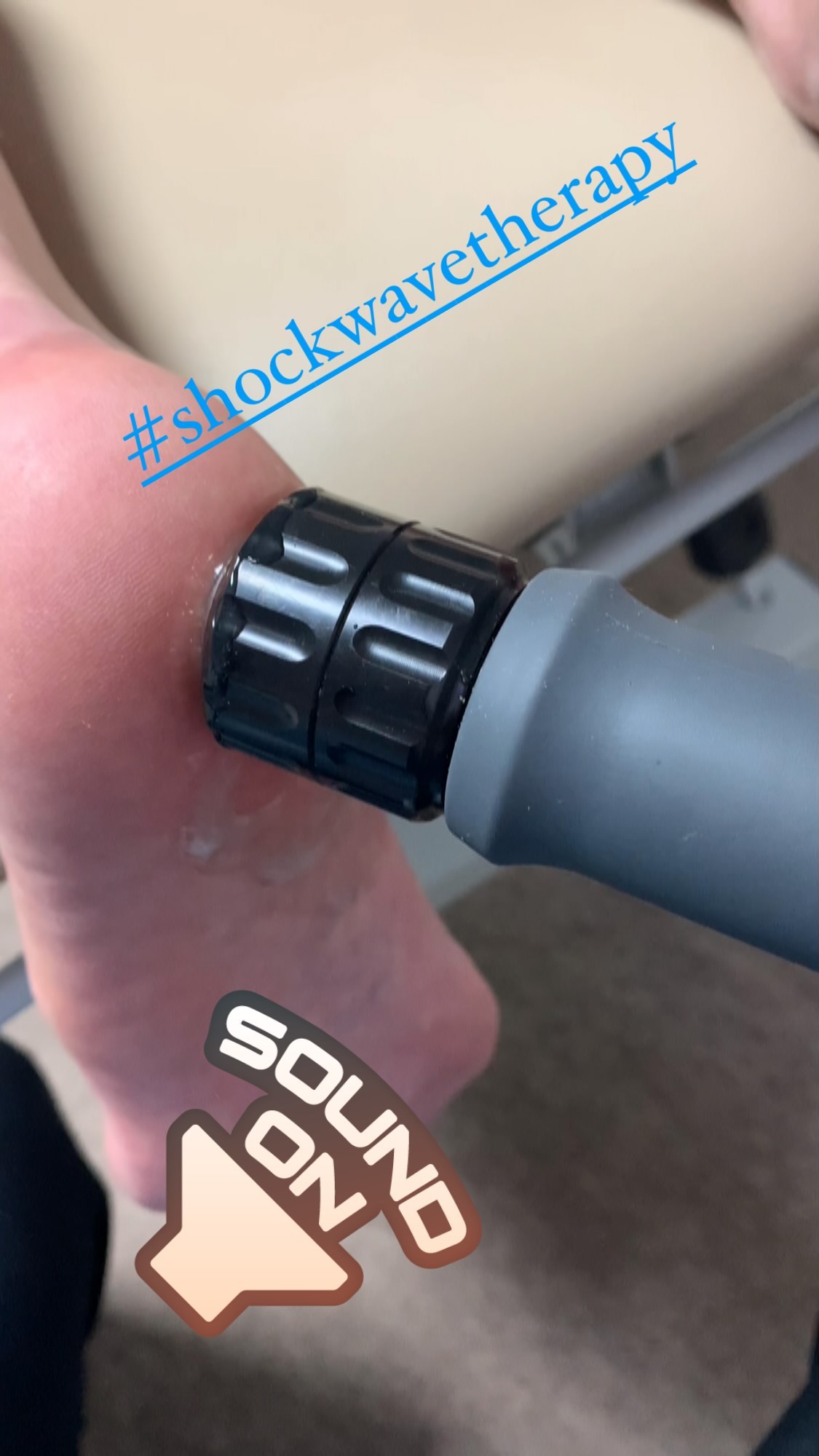 Shockwave therapy for chronic plantar fascia pain using gymna shockmaster 300 ⚡️ #shockwavetherapy #shockwavemachine #shockwavetherapymachine #electrotherapy #tendons #tendinopathy #therapy #shocks #physio #physiotherapy