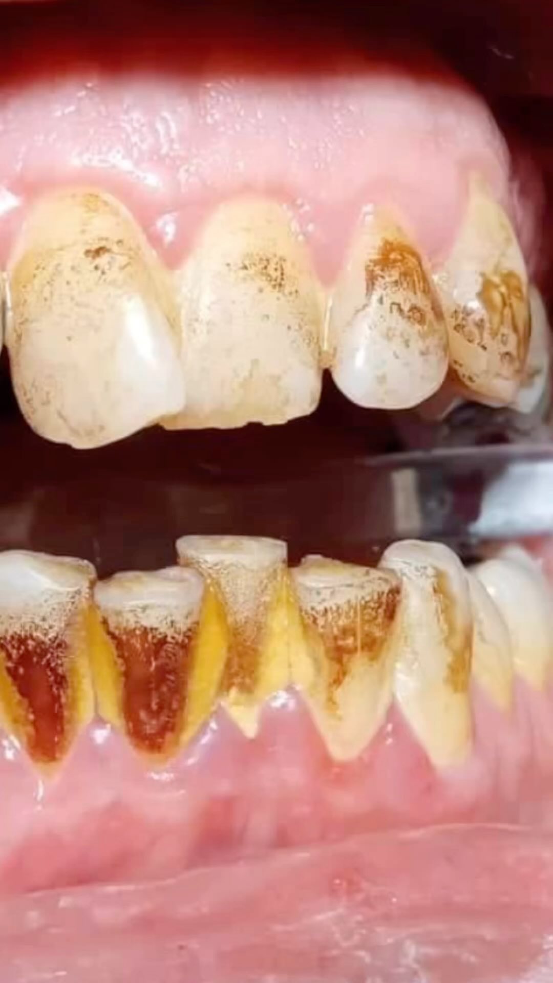 Čištění zubů není tak jednoduché, jak se zdá. Ústa mají svá zákoutí, kam se běžným kartáčkem nedostanete. Na dentální hygieně Vám odstraním zubní kámen, plak a pigmentace. #teethwhitening #belenizubu #praha #prague #prevdent #dentalhygiene #dentalnihygiena #newlook #teethcare