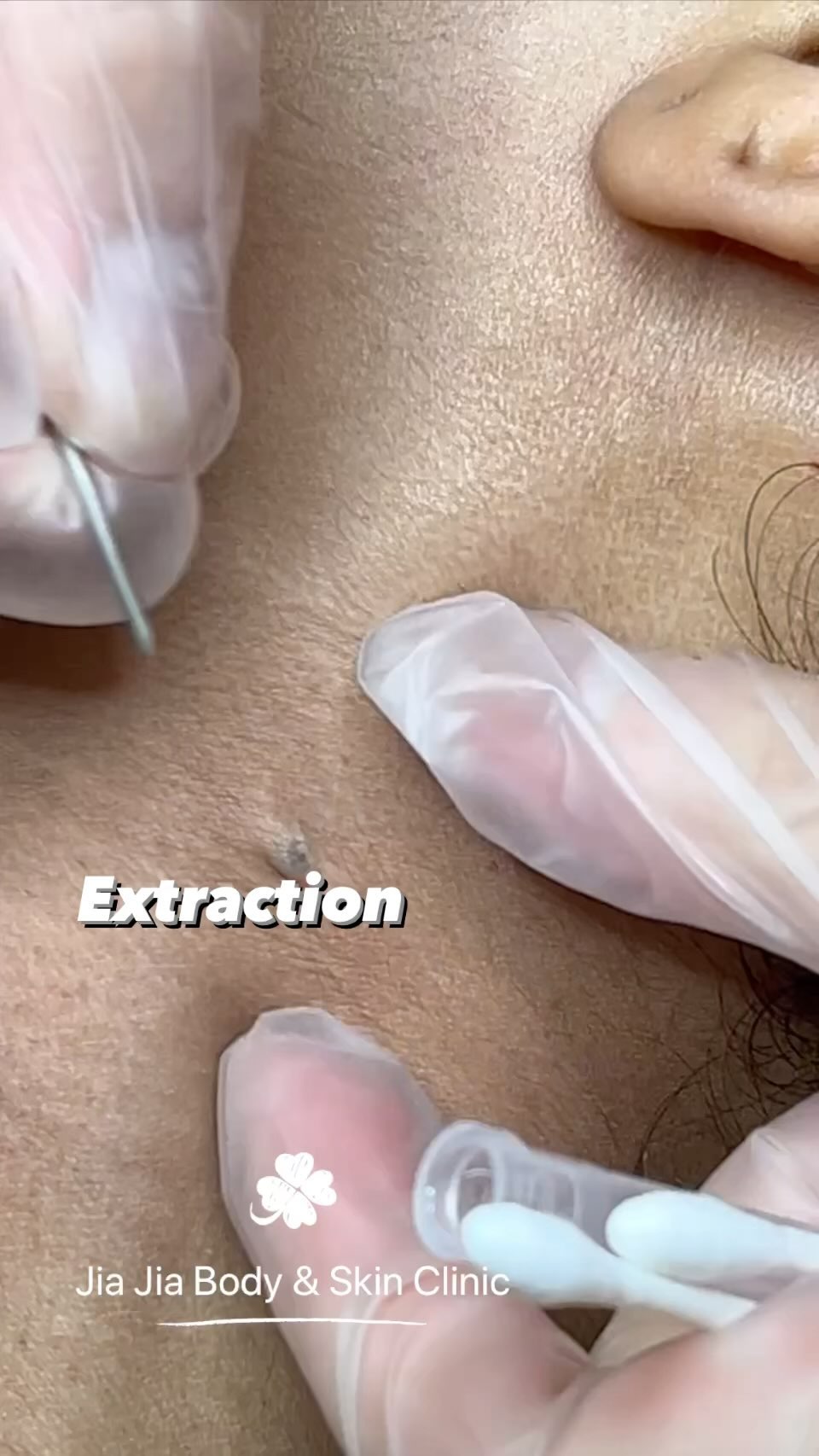 Extraction by Jia Jia
#jiajiabodyandskinclinic
#extractions
#clearskin