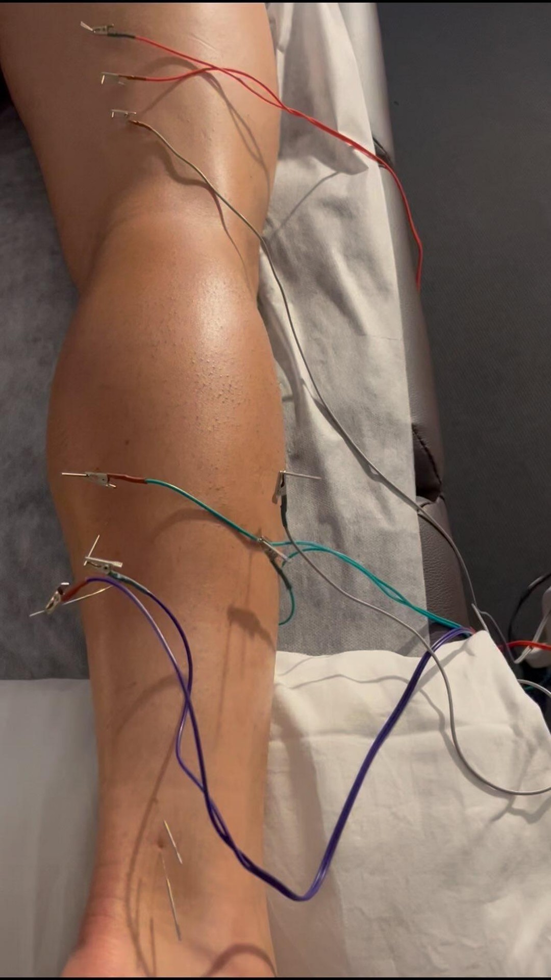 ⚕️Akupunktūra su elektros stimuliacija, po Pro futbolo sukelto M. Soleus raumens plyšimo ir šlaunies dvigalvio raumens atpalaidavimas.
Akupunktūra su elektros stimuliacija pagreitina traumos gyjimą, mažina skausmą, gerina kraujotaką, mažina pažeisto audinio “scar tissue” susidarimą.♨️