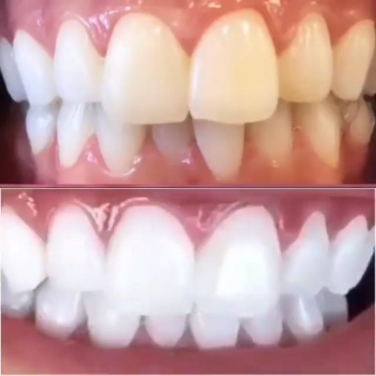 Klinik Tandblekning 
ERBJUDANDE 1490 KR (Ordinarie pris 4900 kr)
ONLINE TIDSBOKNING
www.DentalClinicSweden.org🔺️ BOKA FÖR 2 PERSONER & FÅ YTTLIGARE 200 KR RABATT!
 #tandblekningstockholm #TandblekningStockholm #stockholm #liljeholmen #KlinikTandblekning #TandblekningGöteborg #TandblekningUppsala #TandblekningUtbildning #fillers #fillersstockholm #fillersgöteborg #fillersmalmö #TandblekningsUtbildning