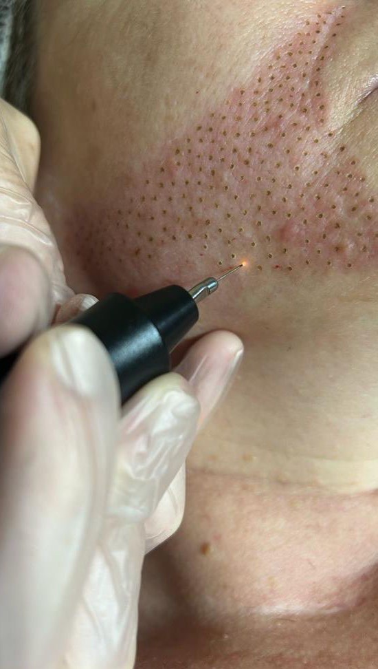 Esta temporada renueva tu piel y revela tu belleza natural con la magia del PLASMAPEN en Centro Frida 💫
Y aprovecha nuestro 10% de descuento en el tratamiento, hasta el 30 de septiembre.
Cuéntanos….¿qué zona te gustaría mejorar?