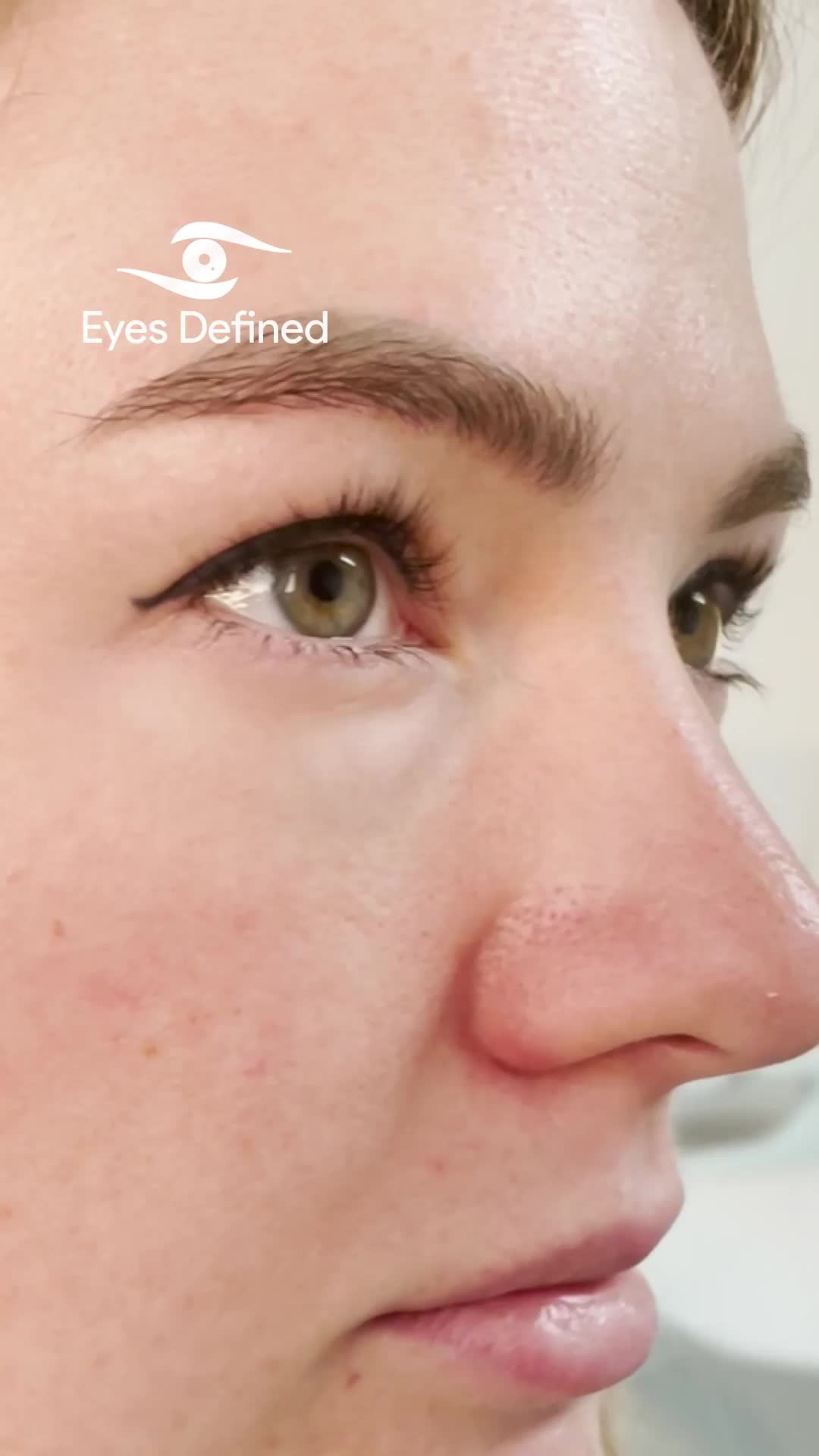 ✨ Final results are in! ✨
This lovely patient underwent bilateral lower eyelid transconjunctival blepharoplasty with fat repositioning — all done without any external skin scar.
We previously shared her 2-week post-op progress, and now you can see the beautifully natural outcome. No more eye bags, no visible scars, and a refreshed look that still looks like her.
This technique allows for precise sculpting of the lower eyelids while preserving the integrity of the skin — ideal for patients wanting a subtle, scarless rejuvenation.
📍Performed in London by a specialist oculoplastic surgeon.
#BlepharoplastyLondon #EyelidSurgeryLondon #OculoplasticSurgeon #TransconjunctivalBlepharoplasty #LowerEyelidSurgery #NoScarBlepharoplasty #FatRepositioning #NaturalResults #EyeBagRemoval #LondonAesthetics #EyelidRejuvenation #Oculoplastics #FacialAestheticsLondon #BlepharoplastyBeforeAndAfter #EyelidExpert #LondonSurgeon #YouthfulEyes #RefreshYourLook #ScarlessSurgery