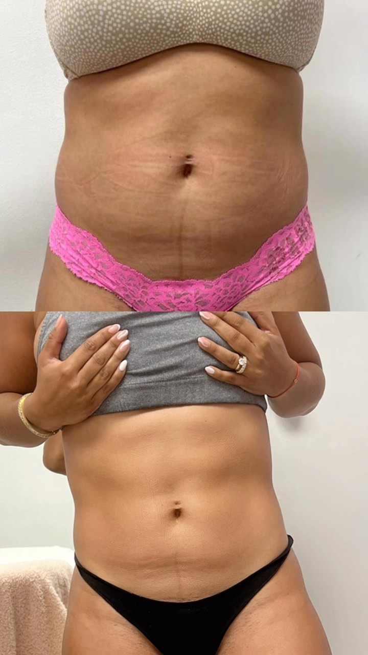 Beautiful progress!🥰😍🙌🏻
.
.
.
.
.
.
.
#massage#woodtherapy#reels#workout#body#facials#skincare#love