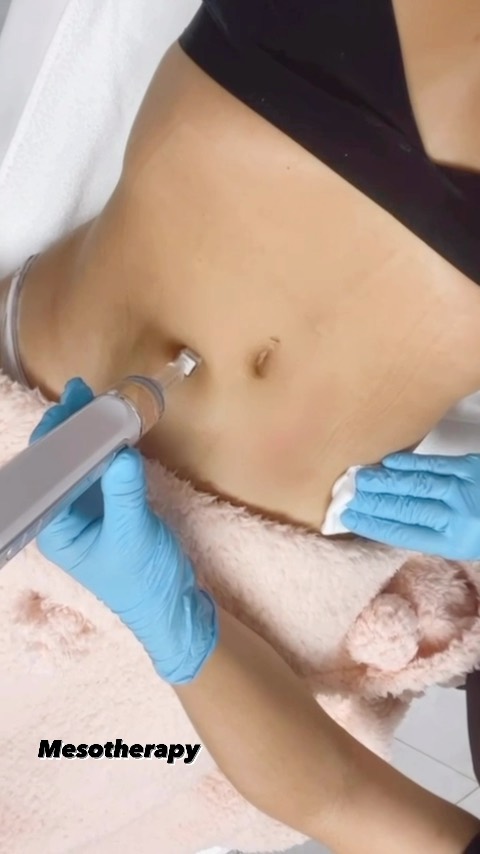 Mesotherapy💉 Body mesotherapy is a technique that uses painless intradermal injections to mainly treat areas affected by cellulite and localized fat. These infiltrations introduce into the affected area assets such as vitamins, minerals, amino acids, etc…………………………………………………………………fatburner#mesoterapybody#nomorefatbelly#nomorecellulite#noinvasiva#smartpen#microneedling#dermapentreatment#instalike#instareels#fallowme#lynphaticdrainage#handmassage#aparatologia#waxing