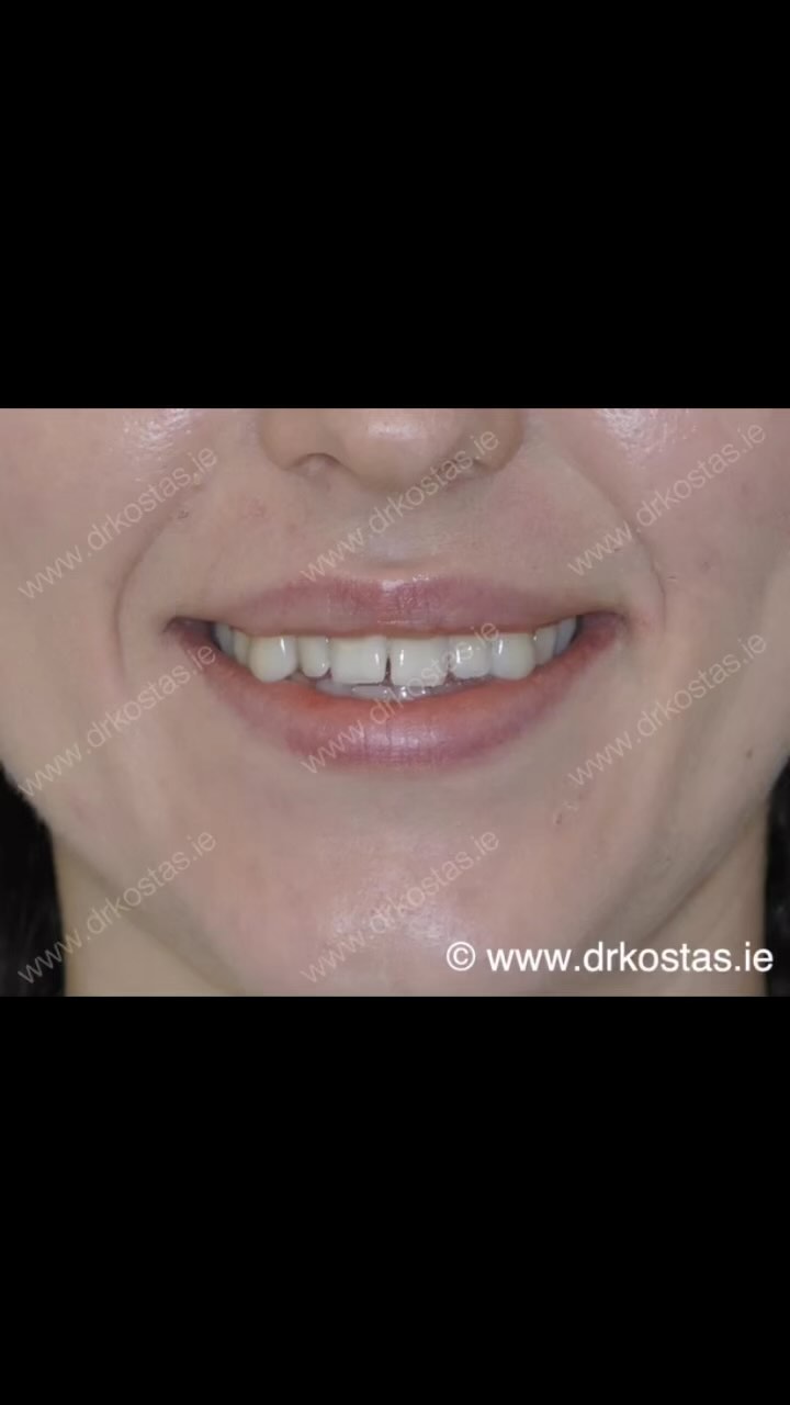One of the most important aspects of an attractive smile is the “Smile arc” (also know as “Smile curve”). It is the relationship between the curvature of the edges of the upper front teeth and the curvature formed by the lower lip when smiling. In the example below this is very well demonstrated. Always trust your smile to a Specialist Orthodontist 😁🙌
#drkostas #kostasortho #orthodontist #braces #dublin #smile #smilecurve #smilearc #orthodontics #straightteeth #damonbraces #cosmeticdentistry #smilemakeover #smiletransformation