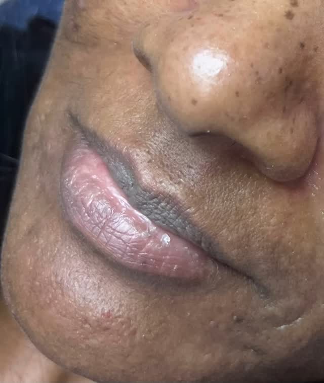 Dark lip neutralization healing process, 1st session. #hollyjoypmu #lasvegas #permanentmakeup #liptattoo