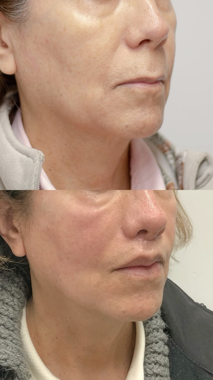 💉Upper Lip Lift
⏰ 2 meses de evolución
¿Te gustó el resultado? 💞