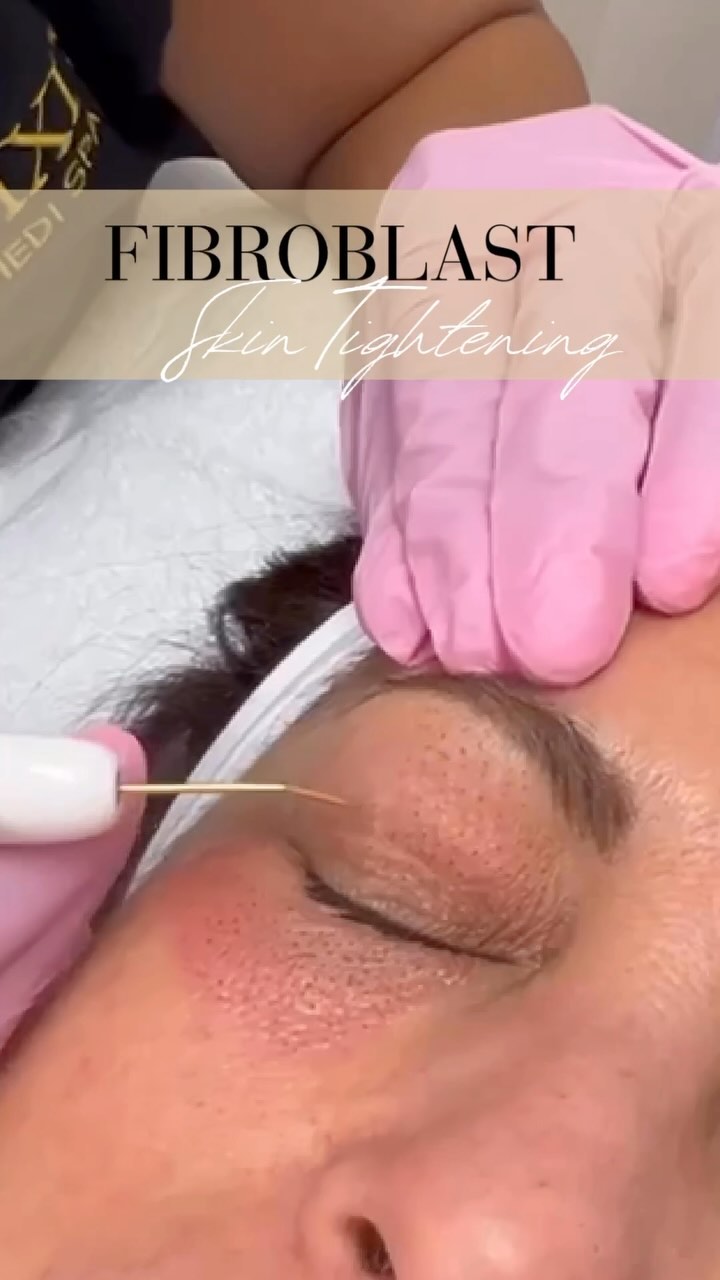 Say goodbye to saggy skin and imperfections with Plamere Fibroblast skin tightening!🧏🏻♀️✨ This non-invasive procedure tightens, lifts, and reduces wrinkles and fine lines with minimal discomfort and downtime⏱️🤏🏽
Experience a safe alternative to plastic surgery and enjoy stunning results 🤩✨✅
#skintightening #result #safe #medicalspa #fibroblast