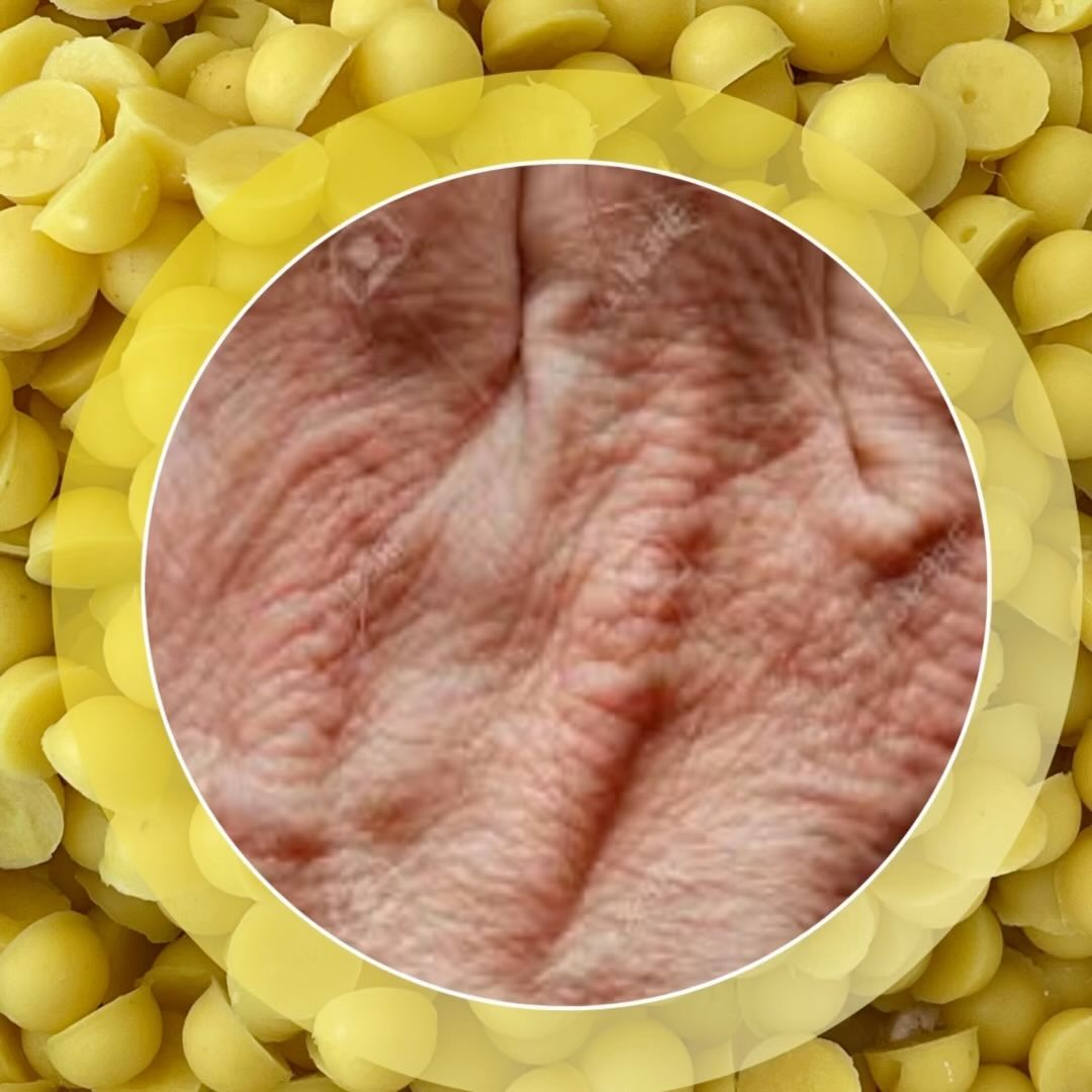 Do your hands 🙌🏻 look like they belong to your mother?
We usually forget about our hands and give all the attention to the face.. until it’s too late ⏰
All those needles 💉 , lasers and peels make our face look much younger than our hands.
Yes, you can do some treatments on your hands but no one will put filler or botox in your fingers. 🤦🏻♀️ Believe me, I’ve tried.
🔴🔵🟢🟡🟣🟠
Even if you think it’s too late for your hands to recover, Butter Bits can help.
The wax and butters in Butter Bits fill the creases of the skin and soften and smooth wrinkles.
They add volume so the skin looks and feels more supple and smooth.
Why not try them for yourself?🤷🏻♀️
Use code CALM for 50% off a 50 pack of Calm Butter Bits.
Do it. Do it now! 😂
#lotionbar #lotionbars #mealprep #veganmealprep #mealprepideas #plantbasedmealprep #whippedbodylotion #dryskincare #dryskinproblems #dryskinrelief #sensitivedryskin #sensitiveskin #handcream #handcreams #veganskincare #plantbasedvegan #plantbasedskincare #plantbasednurse #plantbasedmeals #nurse #nurselife #nursesofinstagram #momsofinstagram #momswholift #mommymakeover #handsthatmake #drycuticles #handcare #handcareproducts