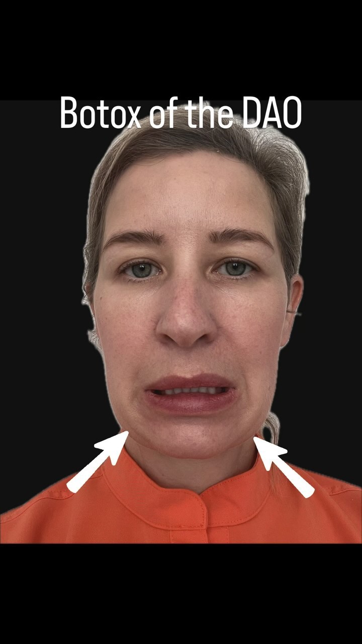 Botox in the lower face really helps to reduce resting tension. Reducing the downward pull of the depressor muscles (DAO) improves the appearance of jowls and gives a little lift & tightening along the jawline. #southlondonbotox #restingtension #daobotox #lowerfacelift #lowerfacebotoxmagic #lowerfacebotox #jowlinelift #jowloptions #improvemyjowl #botoxlift #botoxjaw