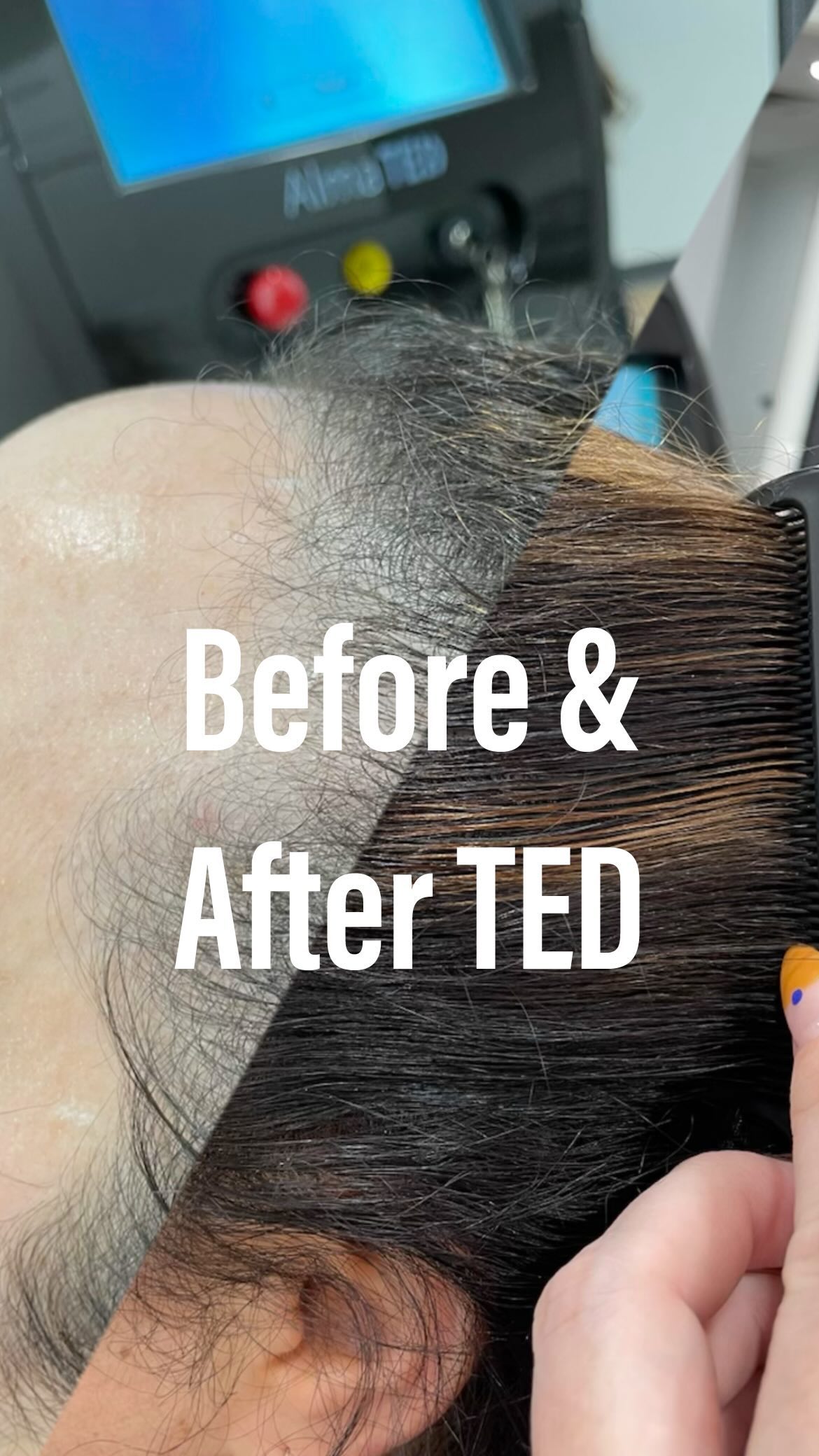 Before and after TED treatments! 🤯😍
TED Hair Restoration is completely painless and 100% of clients have had visible improvement as well as overall strength, shine and LESS SHEDDING 👏🏻👏🏻👏🏻
I personally have seen such a difference in using TED to PREVENT hair loss when it’s expected: postpartum and post covid.
TED to the rescue!
It’s helped so much, and I didn’t lose a fraction of the amount of hair as I did after those previous hair loss (causing) experiences.
Time to start your hair growth journey!