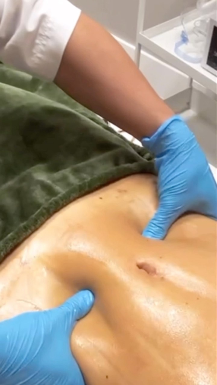 Tuviste una cirugía?? Ven conmigo y te realizo tus drenajes linfáticos que son muy importantes para tu recuperación!!
Did you have surgery? Come with me and I will perform your lymphatic drainage, which is very important for your recovery!
.
.
.
.
.
#lymphaticdrainage #surgery #weightlossjourney #massage#massagetherapy #facials#beauty#wax #waxing#nails#therapy#hallandalearea#aventura#dixiehwy#woodtherapy#tratamientoscorporales#facial