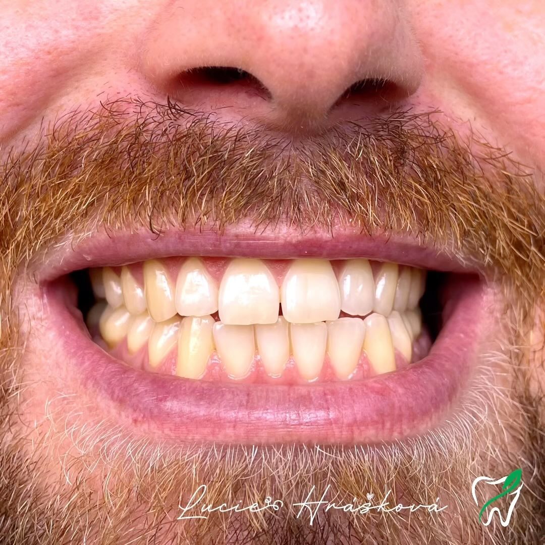 #teethwhitening #belenizubu #prevdent #hrasek #praha #dentalnihygiena #dentalhygienist #beforeandafter #smile