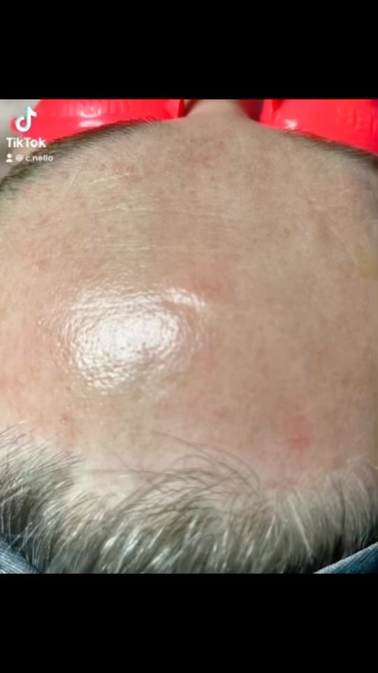 TRANSFORMATION
I’ve been meaning to show this to my client multiple times in their appointments just what it does exactly to those forehead lines that they have after an application of the Faux-tox mask. I always end up forgetting but I FINALLY remembered. We were both blown away and I’ve been showing this to my other clients as well who aren’t too sure if they want to try the faux-tox mask.
One year ago, with approximately every 1-2 months for an Oasis Facial, my client told me the results made them look at least 5 years younger that lasted for about 5 days. This year we got that they feel like it lasts for AT LEAST 2 weeks or more! This is the power of stacking argireline without injecting it into the skin and also has to do with my clients amazing aftercare regime at home.
There’s still time to purchase any of the services listed under the December promotion until the very last day of 2022!
#yyc #yycnow #yycbusiness #yyclocal #yycsalon #yycbeauty #yycsmallbiz #yycsmallbusiness #ontheqt #minifacial #yycbeautydirectory #calgary #relaxation #yycspa #yycfacials #hydrojellymask #skincare #facials #spa #skinlove #esthetician #argirelinecontouringmask #argireline #esthetics #yycfacial #beautycare #spafacial #mask #facial #spaday