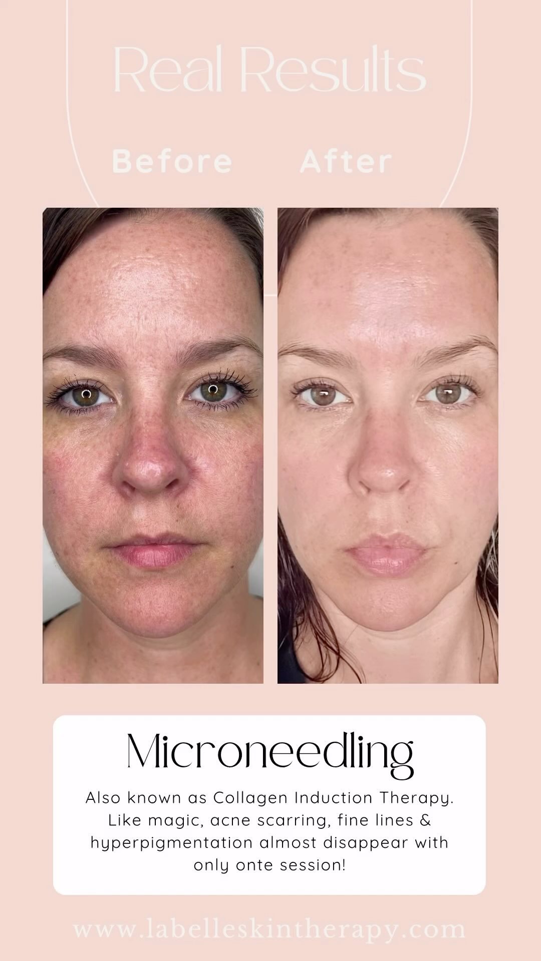 ✨ Check out these stunning results from ONLY ONE microneedling treatment! 🌟
Our clients are glowing with healthier, smoother, and more radiant skin. We can drastically reduce the signs of aging, repair acne scarring, and even diminish hyperpigmentation for an even toned appearance.
Ready to boost your confidence and achieve your dream complexion? Book your appointment today! 💖
#Microneedling #CollagenInductionTherapy #SkinCare #GlowUp #HealthySkin #SkinRepair #AestheticTreatment #RewindAgeing #DiminishFineLines #BrighterComplexion #LoveYourSkin #GlowingSkin #AcneScarringTreatment #WollongongSkinClinic #IllawarraSkinClinic #LaBelleSkinTherapy