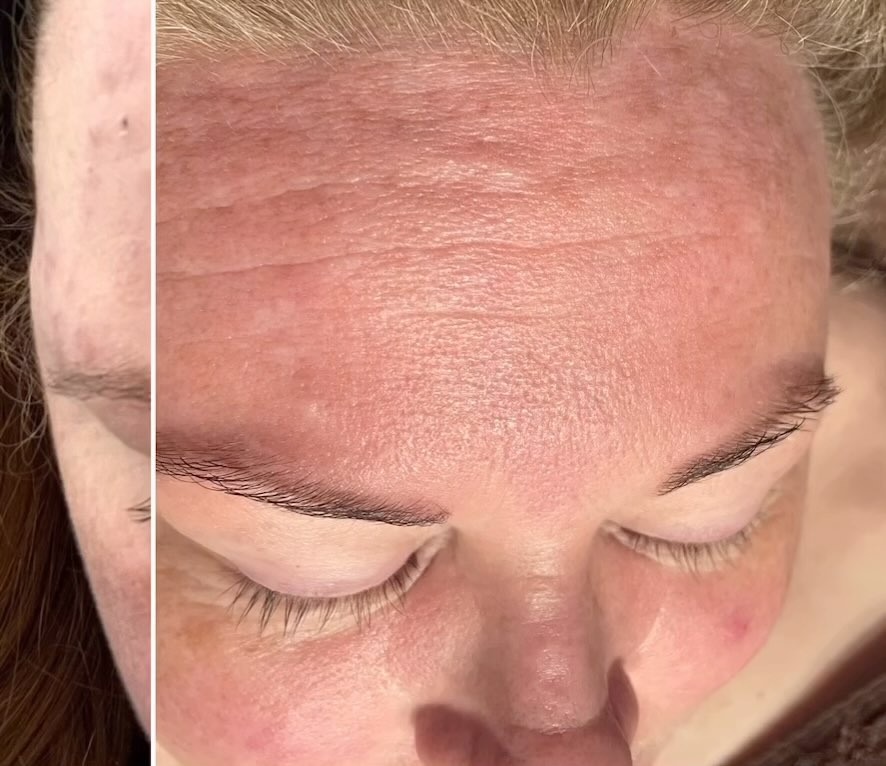 No fancy filters or lights just results. Our Signature facials are different for each person! We use a mixture of LED, Ultrasound, Microcurrents, Micro needling, Manual Massage and Manipulation of the Facial Muscles that are based on the condition of the skin, rather than a type. #results#nofilter#facials