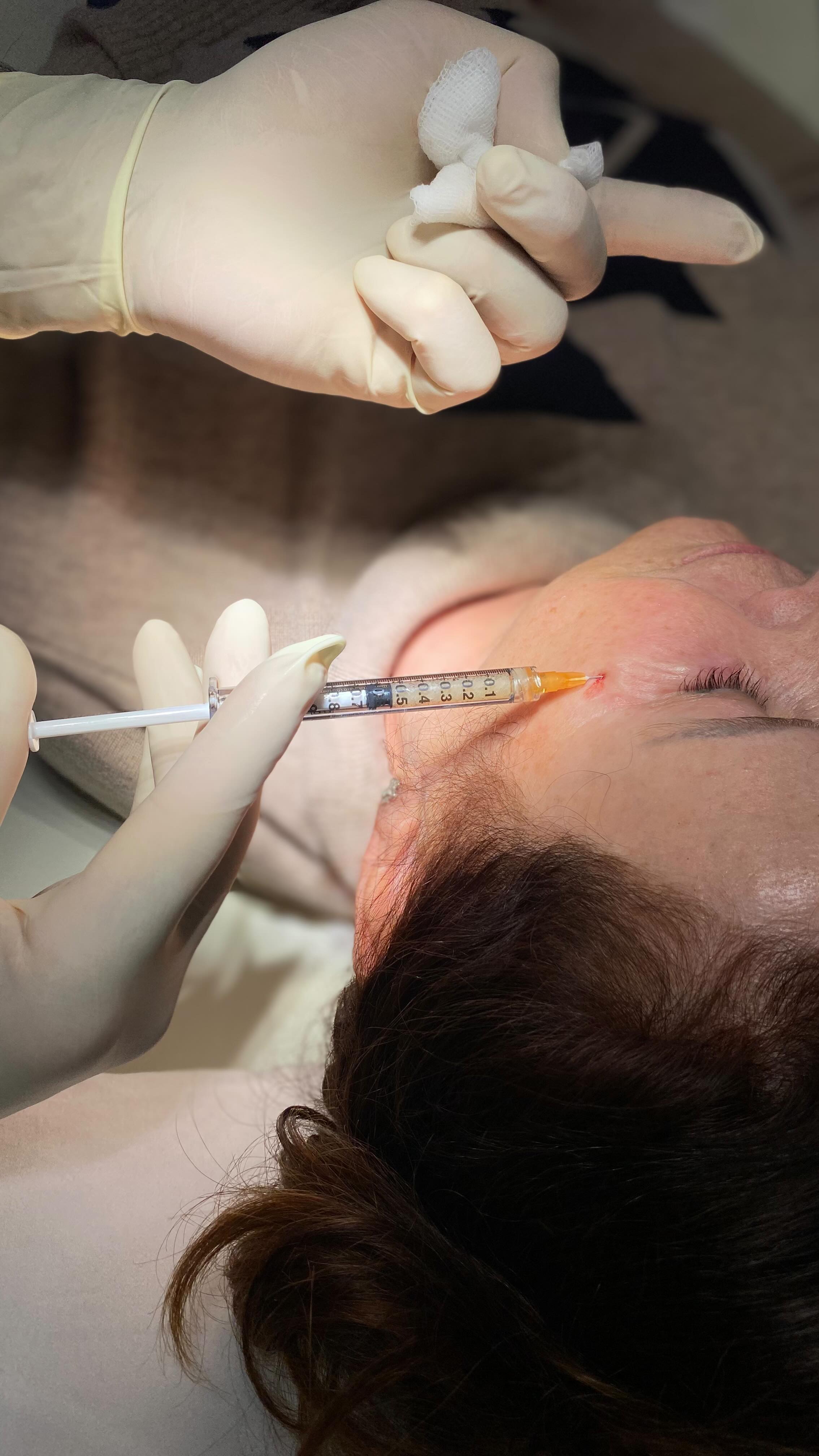 Watch as Your Skin is Transformed Before Your Eyes! In this mesmerizing video, witness the incredible process of PRF Ez Gel treatment, an innovative and non-invasive cosmetic procedure that uses your own blood to rejuvenate and restore your skin’s youthful radiance.
-
Observez votre peau se transformer sous vos yeux ! Dans cette vidéo captivante, assistez au processus incroyable du traitement PRF Ez Gel, une procédure esthétique innovante et non invasive qui utilise votre propre sang pour rajeunir et restaurer l’éclat jeune de votre peau. »
#summitaesthetics #cransmontana #drrajani #prf#doctor #aesthetics #beauty #skin #rejuvenation