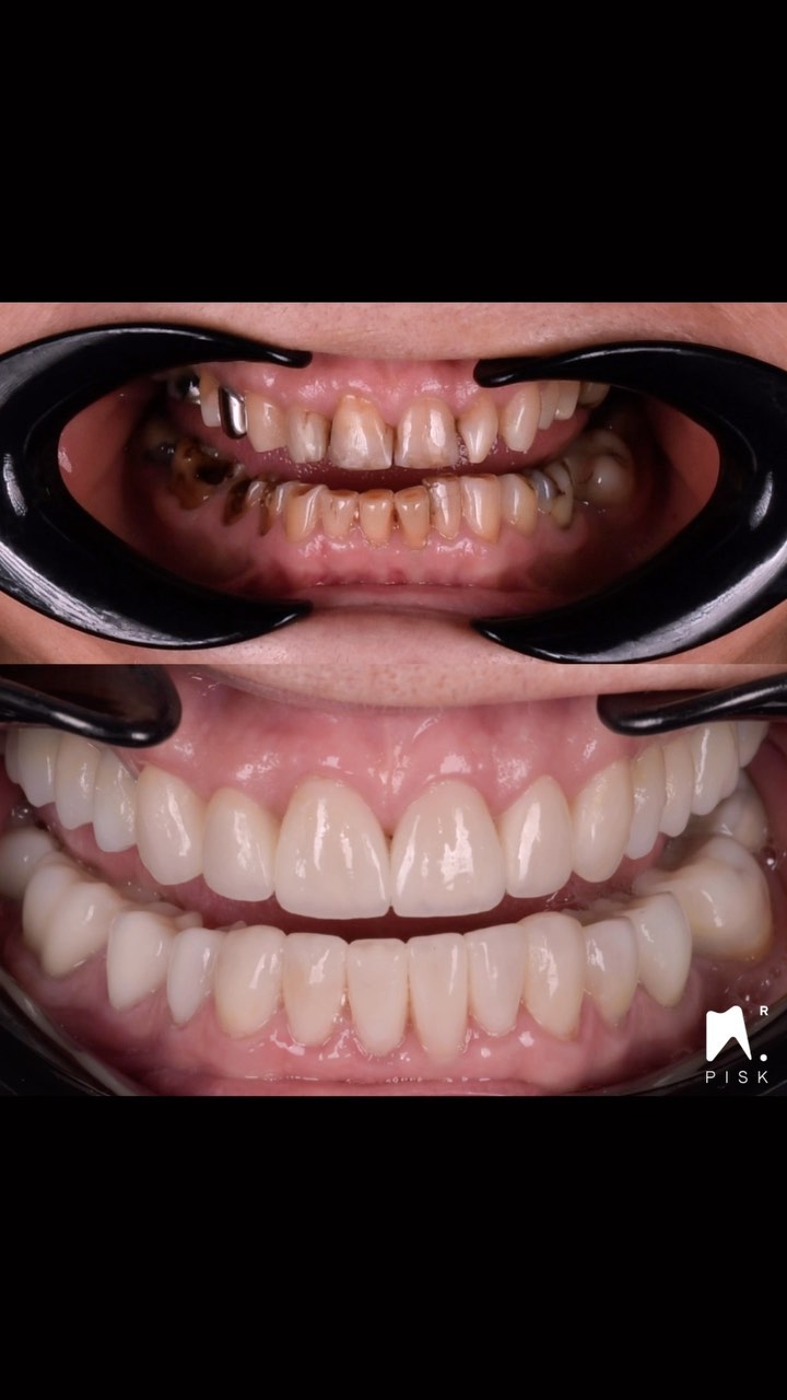 Increasing vertical dimension …
Monolithique and layering in anterior area from tourcoing city @max.lefe
#minimalivasivedentistry #biomimeticdentistry #rubberdam #rubberdamology #nictone #nictonerubberdam #compositebonding #prosthodontics #prosthodontist #directcomposite #estheticdentistry #identistry #dentistryworld #restaurativedentistry #dentalphotography #dentist #dental #facette #veneer