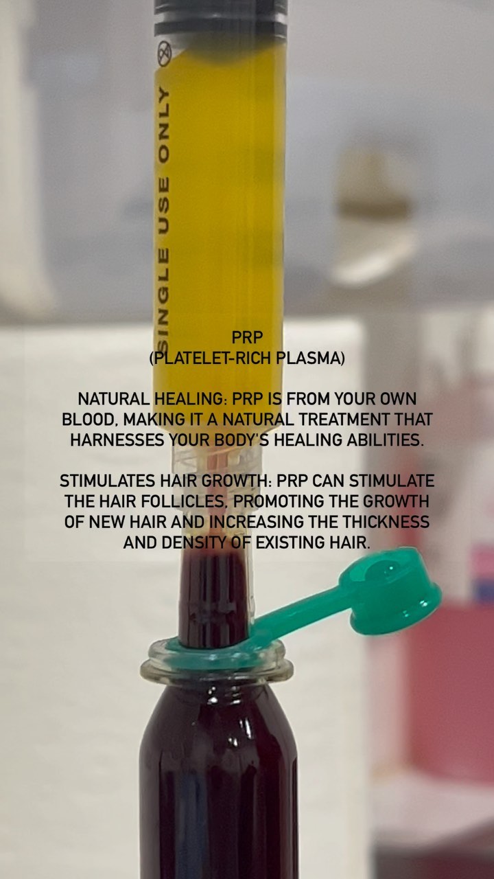 PRP for hair loss ππ§¬β¨ #prp #prpforhairloss #prptreatment